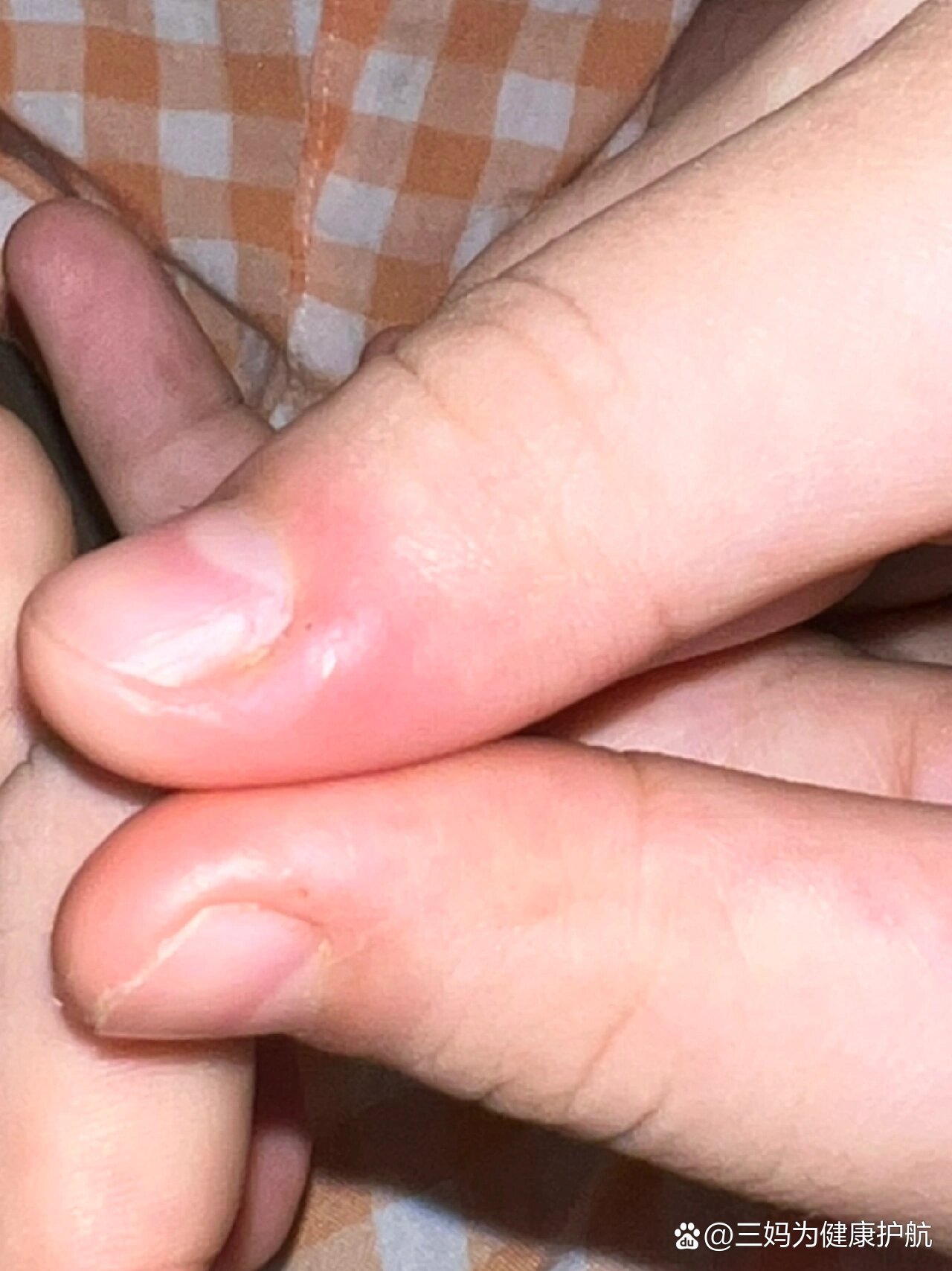 指甲边缘突然发红变硬还疼,咋办