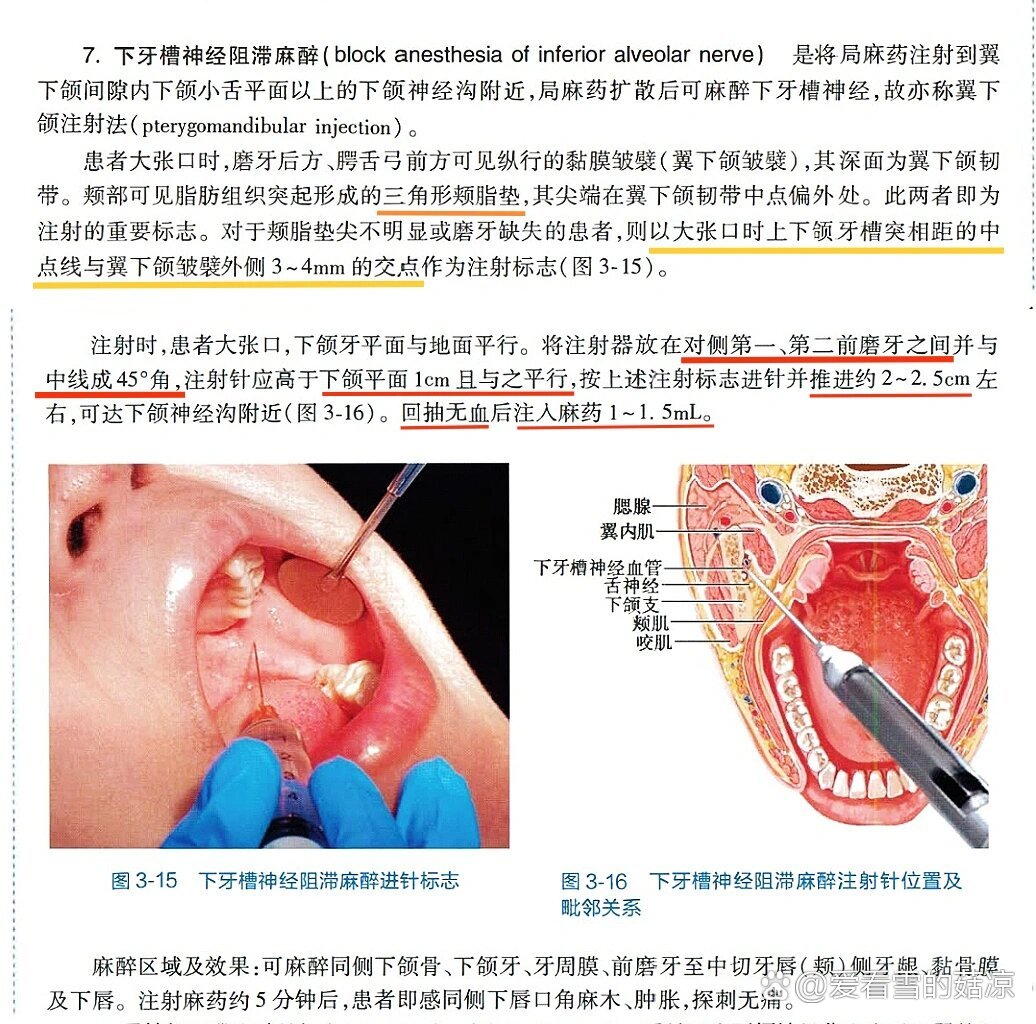 下牙槽神经阻滞麻醉