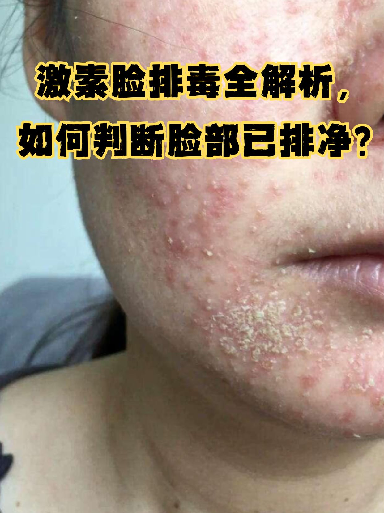 激素脸排毒全解析,如何判断脸部已排净?