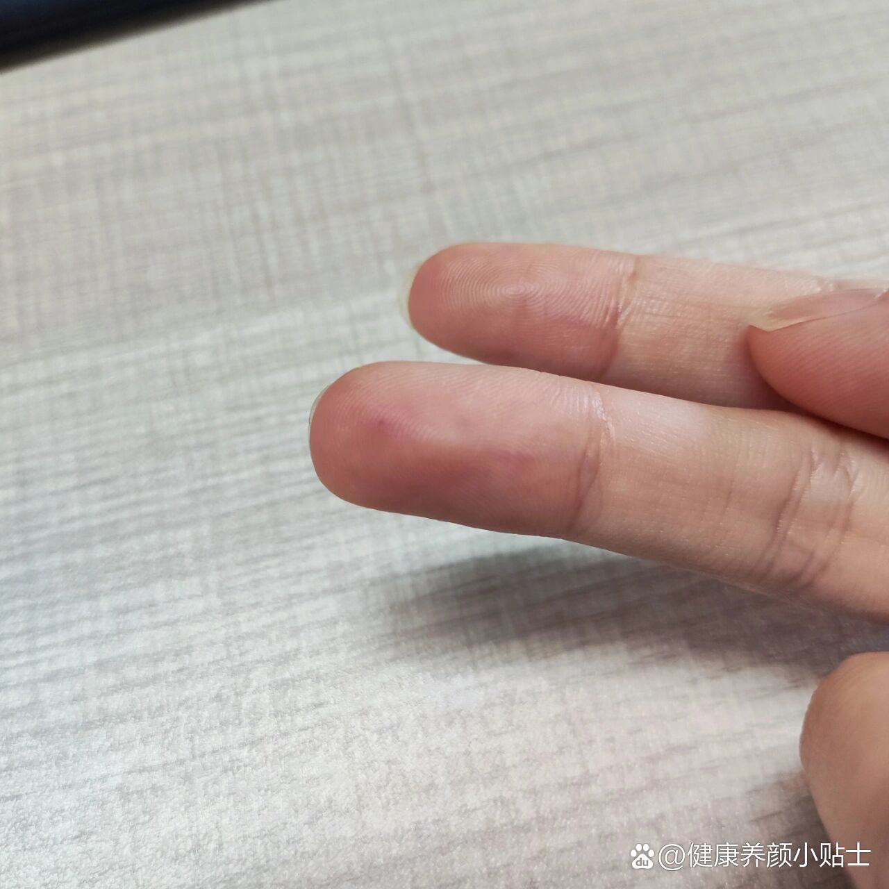 手指头有个针眼大的红点点