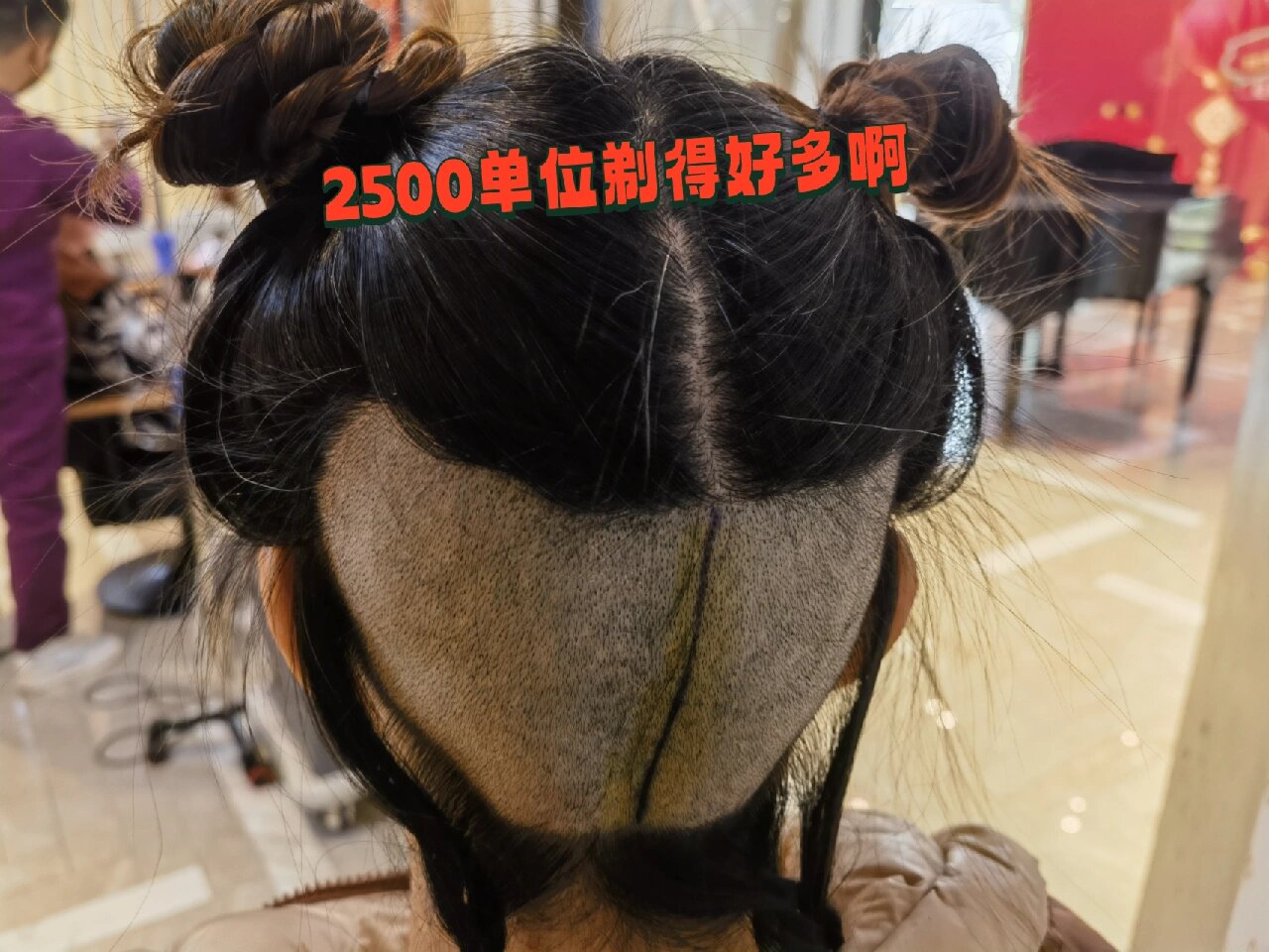 植发板栗(植发起作用吗)