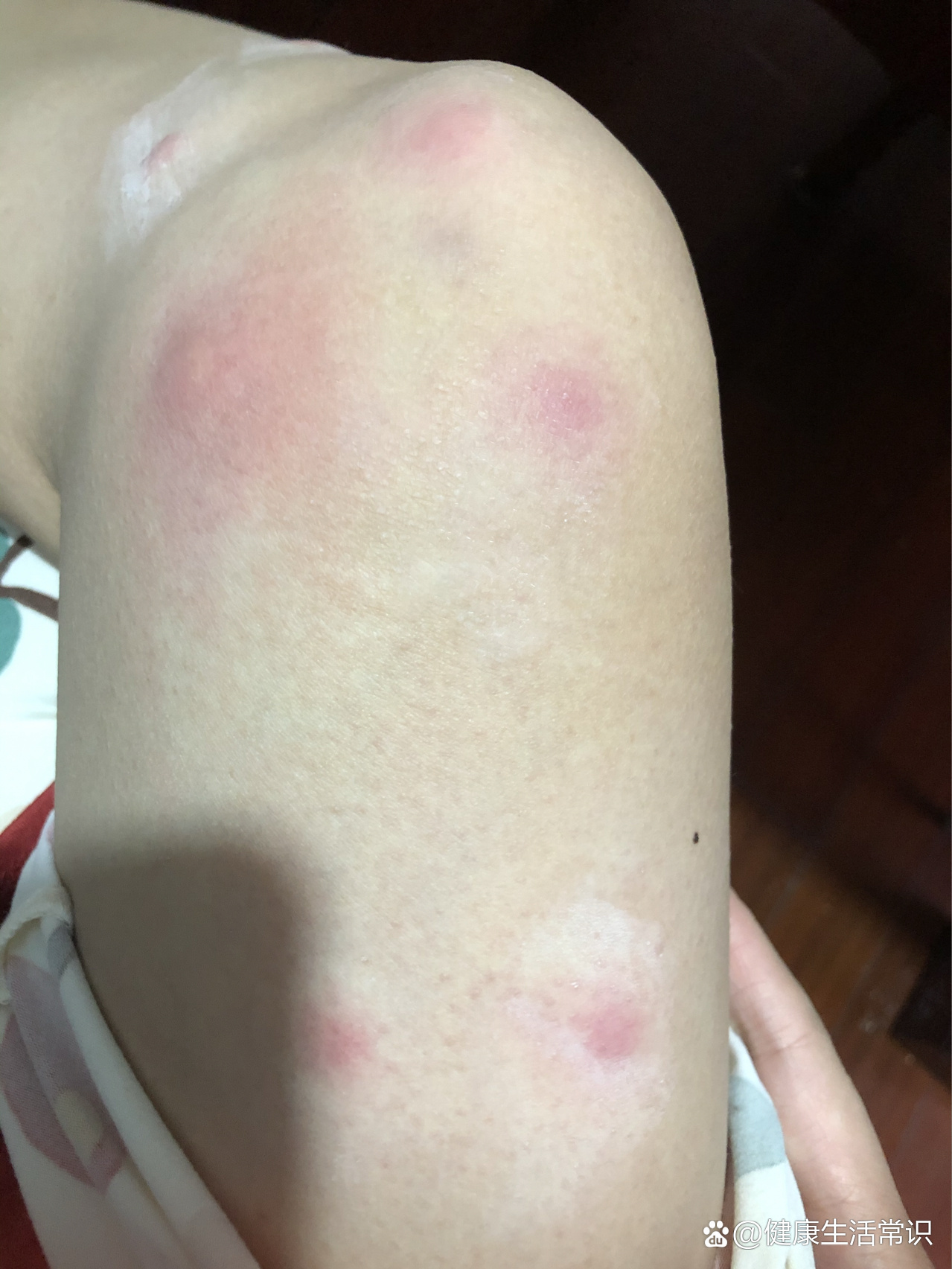 螨虫咬后奇痒无比,太难了