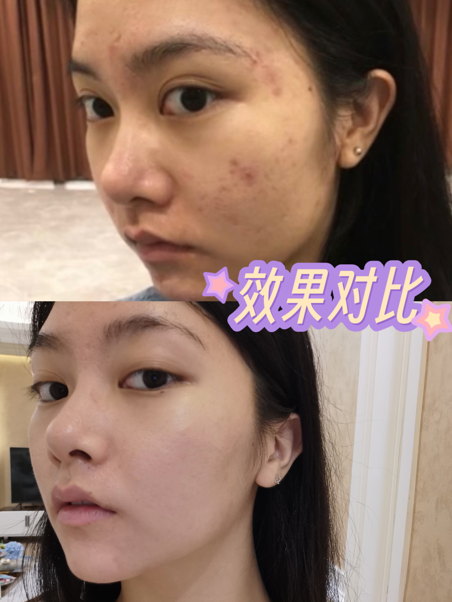 做了两次光子嫩肤的效果图来啦!