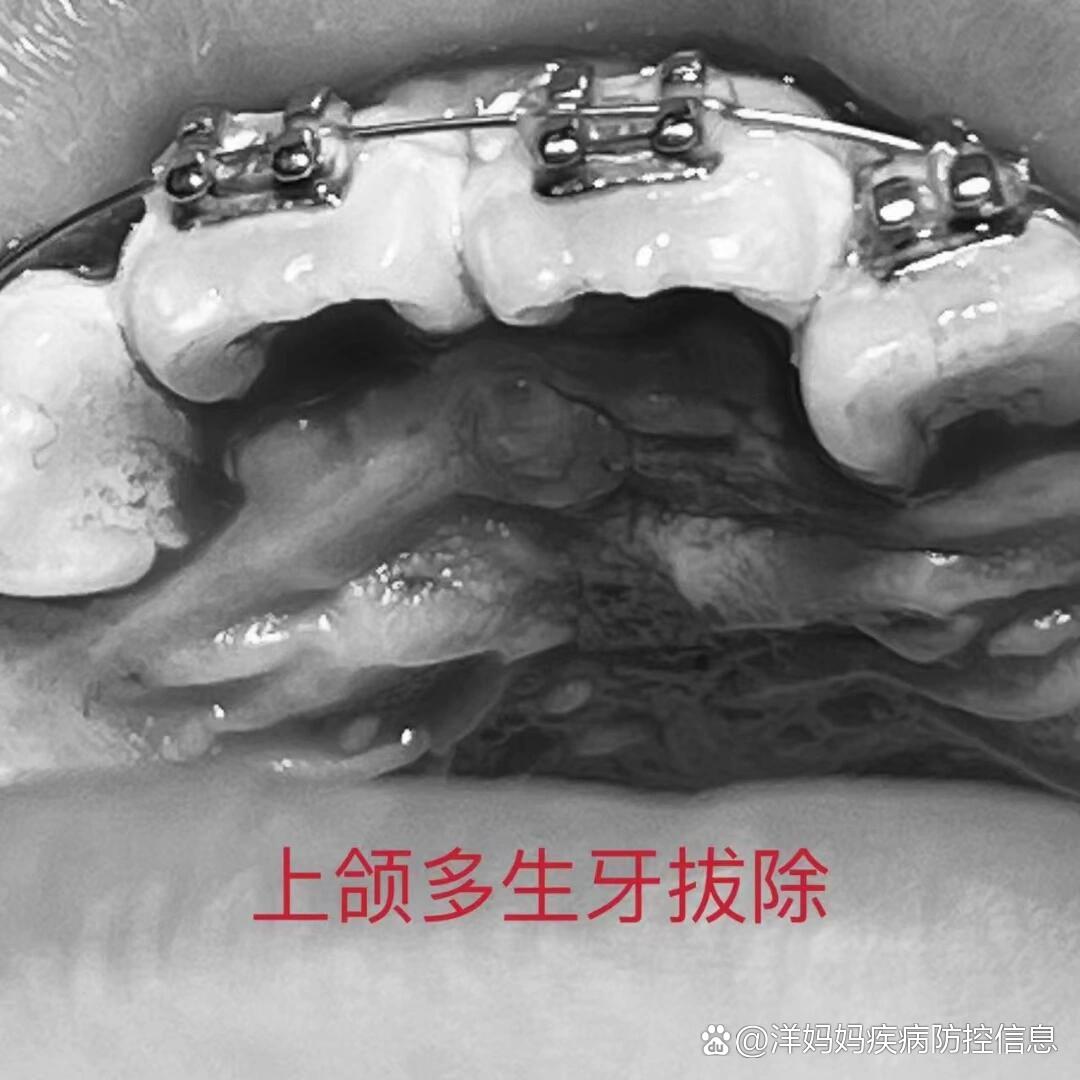 上前牙区多生牙拔除一例