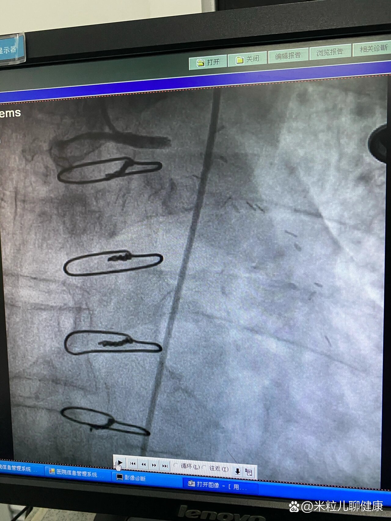 冠脉搭桥术后13年静脉桥血管闭塞急性心梗