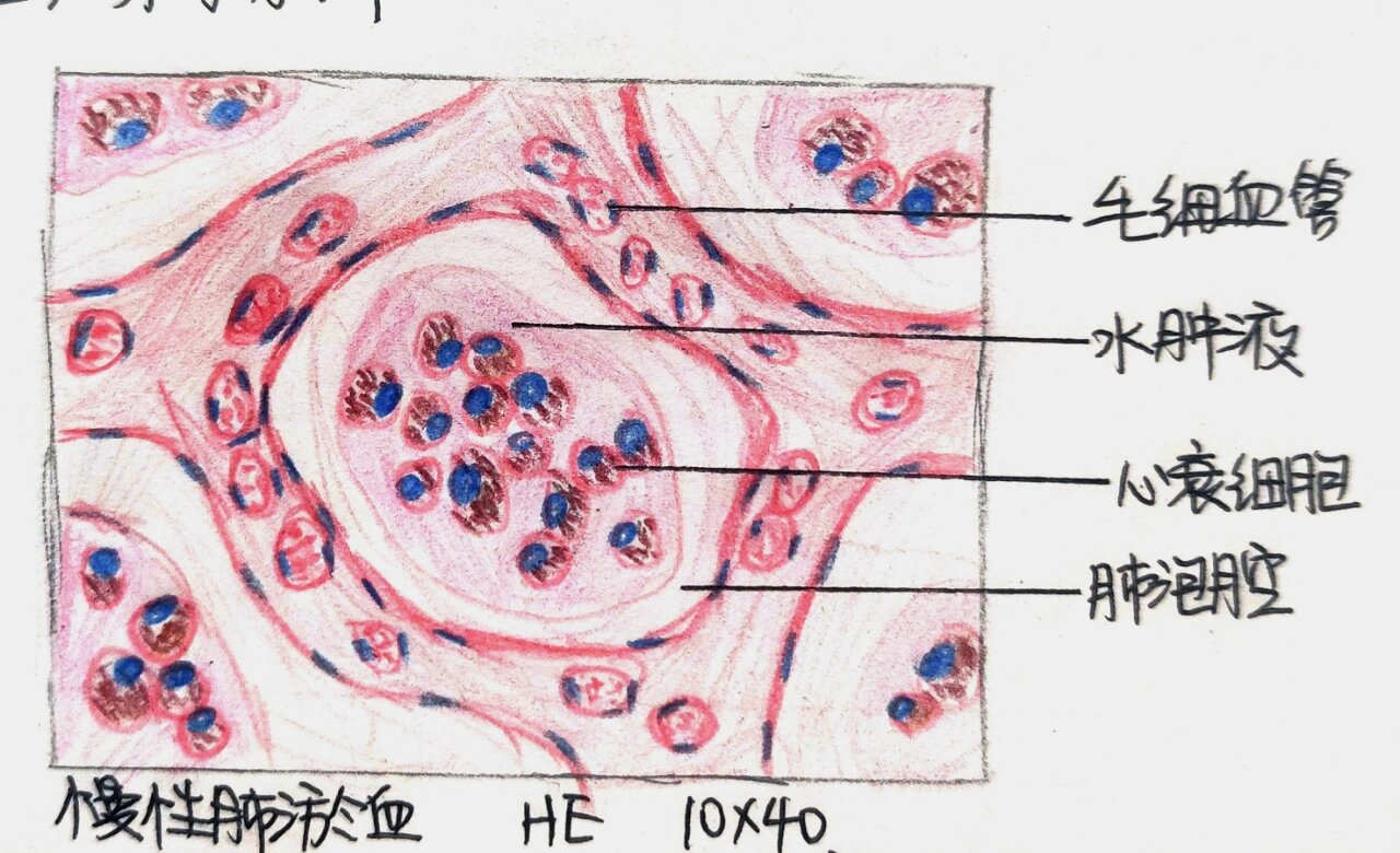  p>病理满分实验报告-慢性肺淤血 br>局部血液循环障碍 红蓝铅笔手绘 