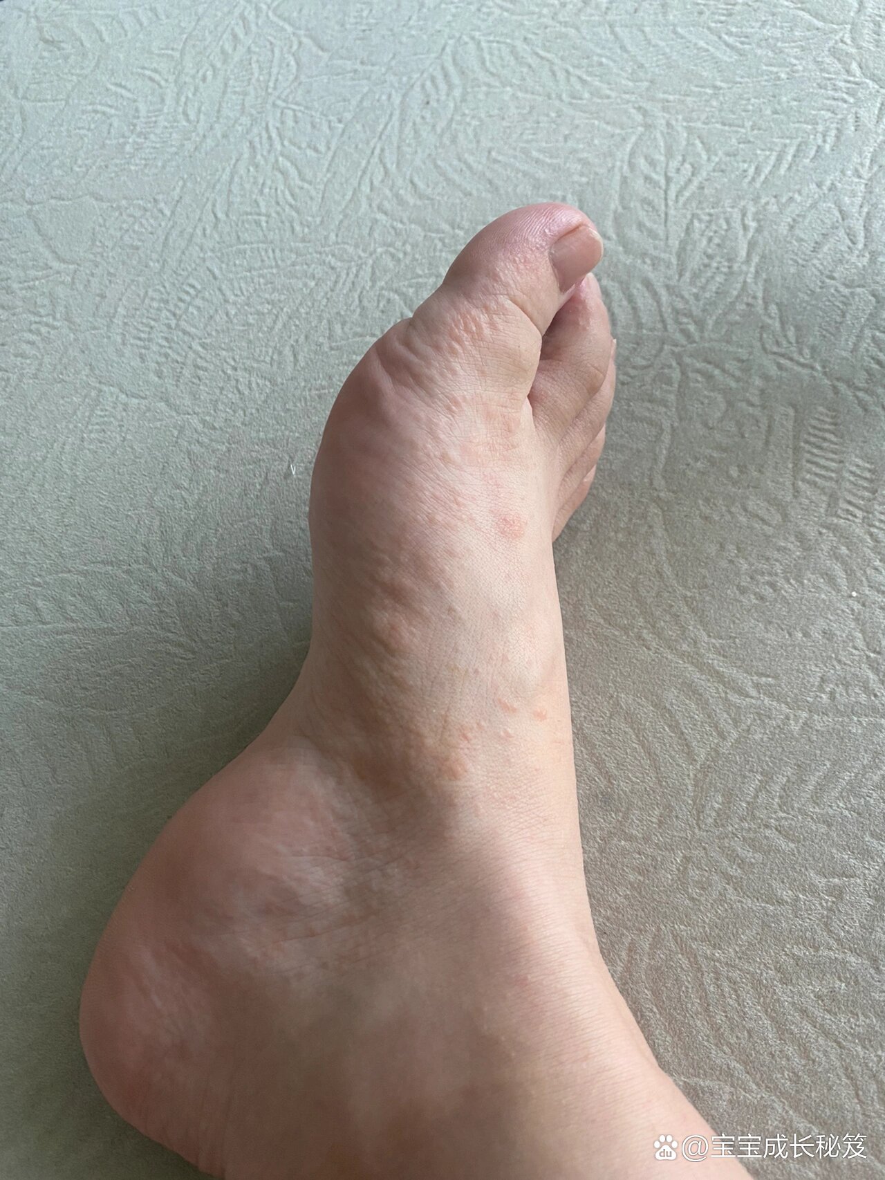 孕晚期休息在家突然爆发汗疱疹