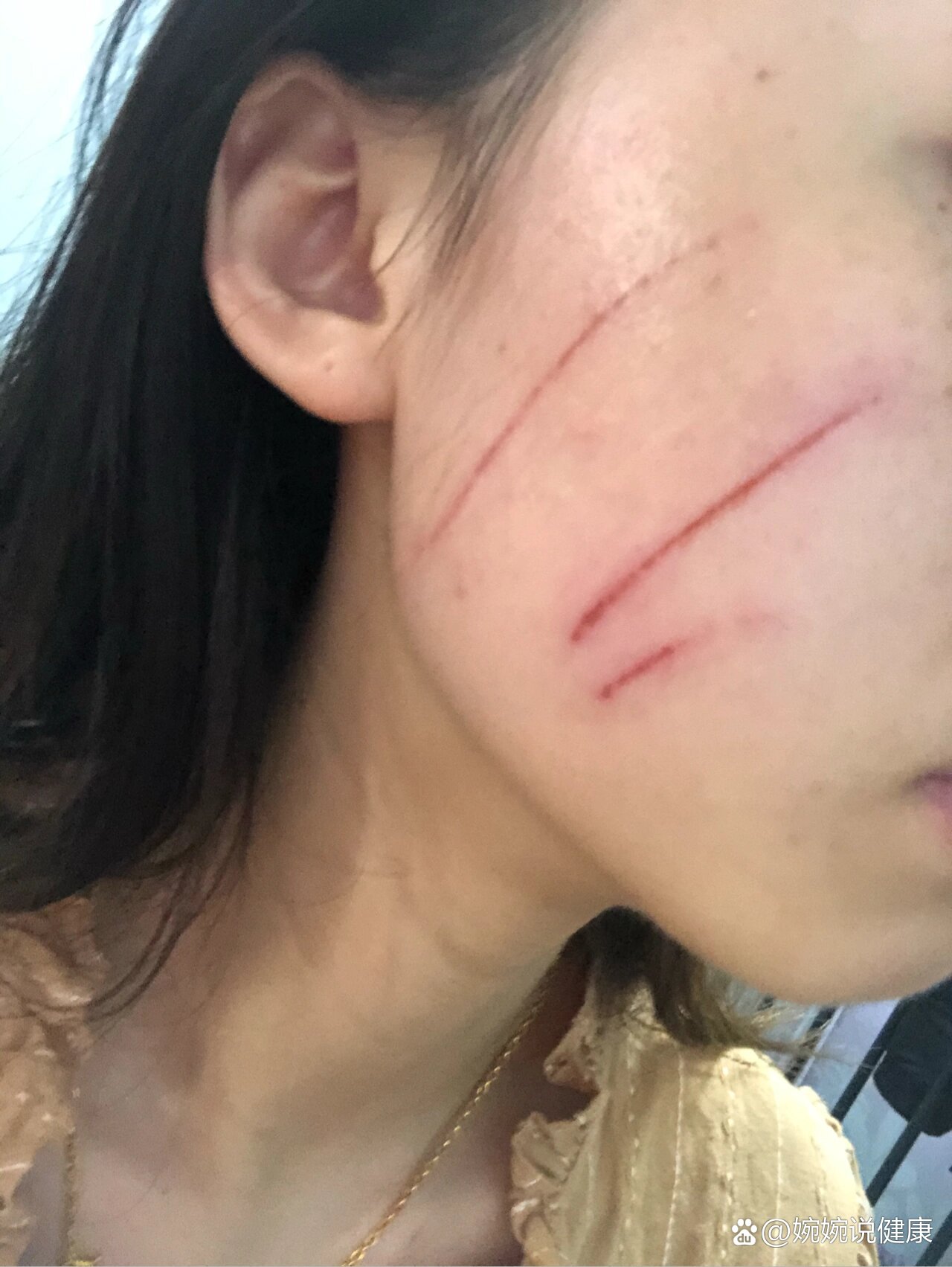 半夜脸被猫抓伤