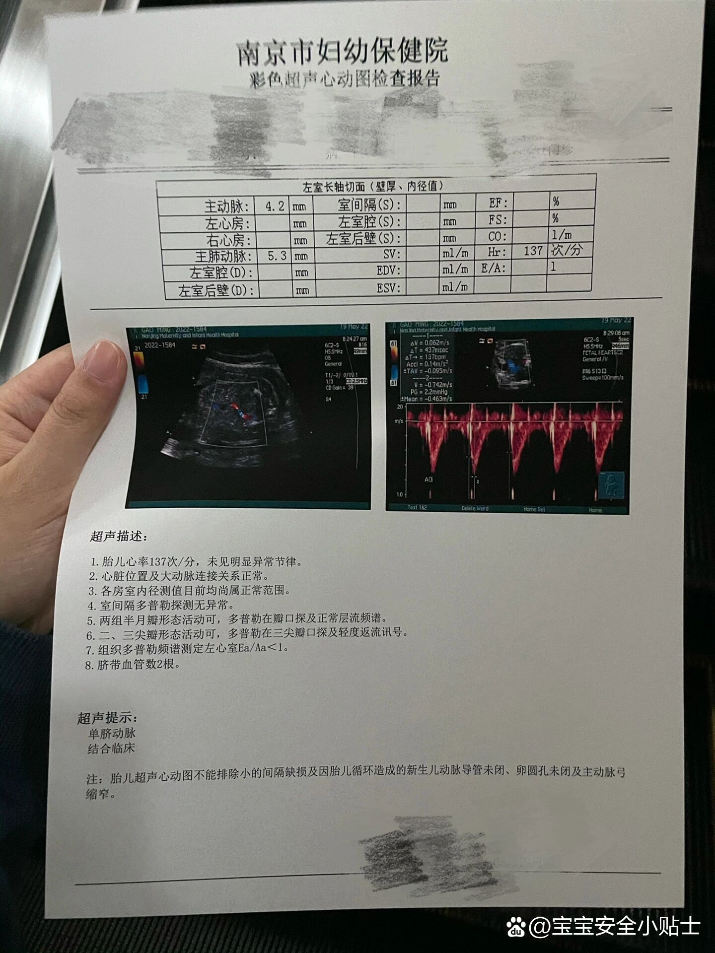 单脐动脉的孕妈不要焦虑
