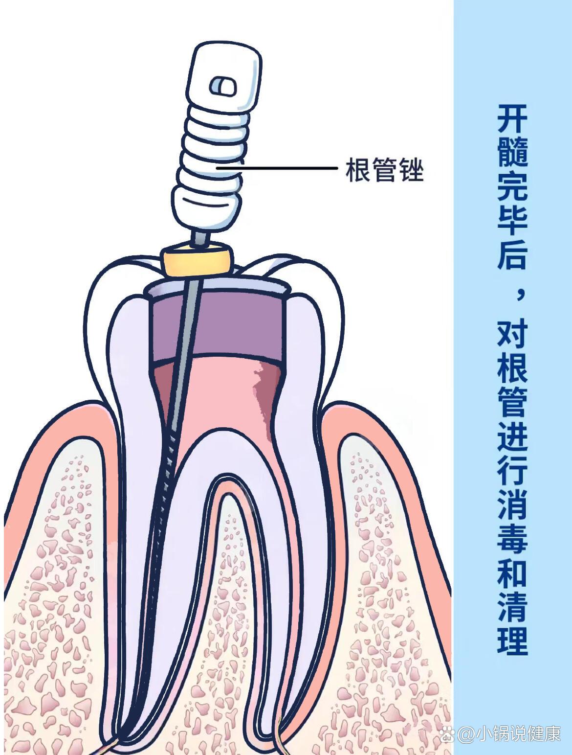  p>根管治療步骤图 br>根管治疗详细步骤,看完就知道怎么做了!