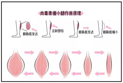 打瘦腿针的危害图片图片