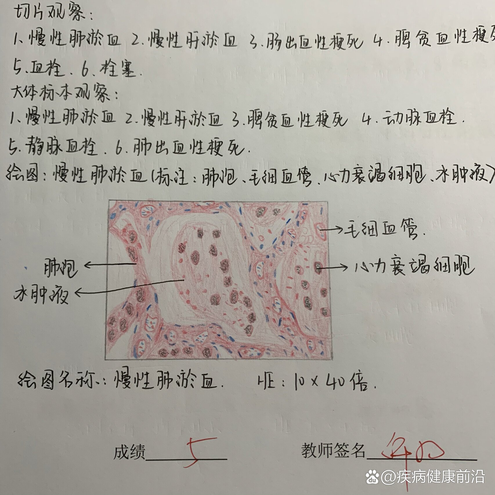 肺淤血切片手绘图图片