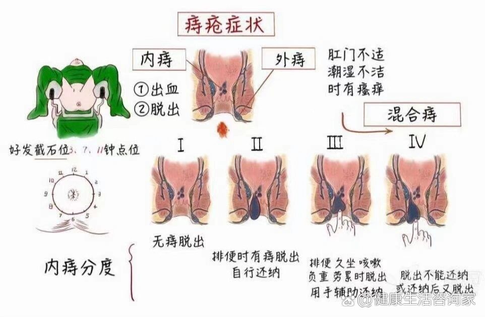  p>痔疮用中药 br>外痔临床常见症状有肛门不洁及异物感,肿胀,疼痛及