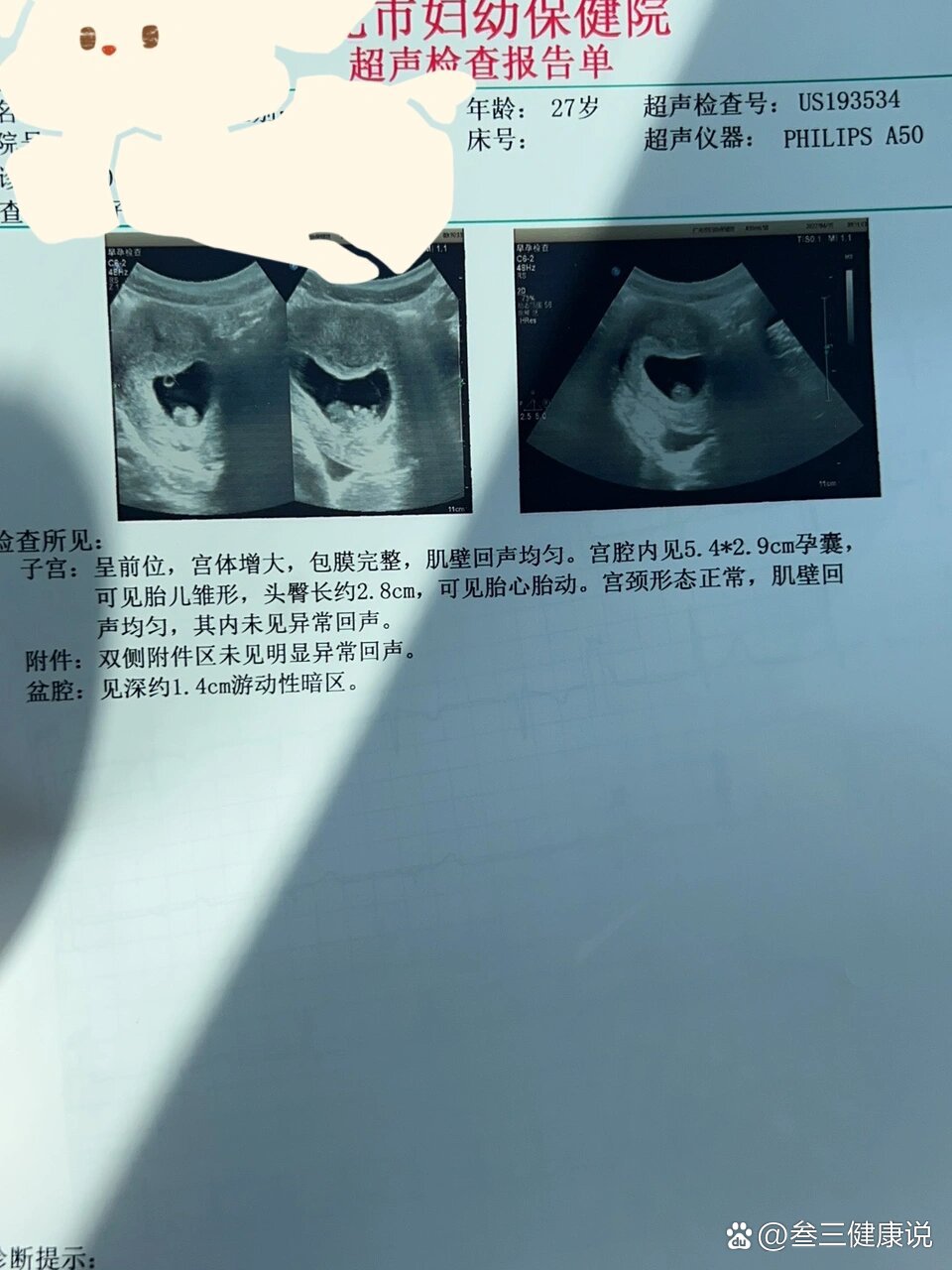 11 5,胎儿偏小两周