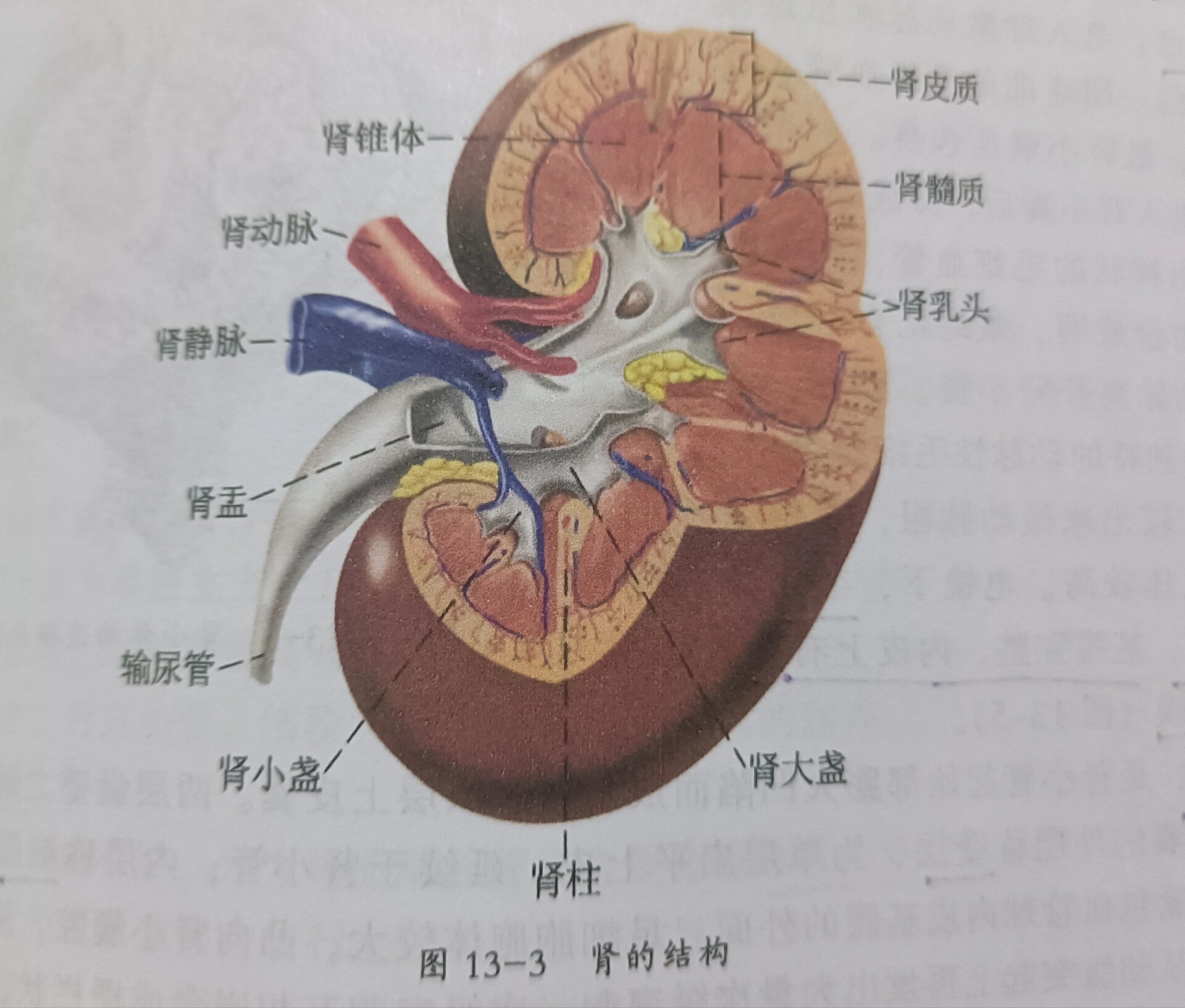 肾窦区结石图图片