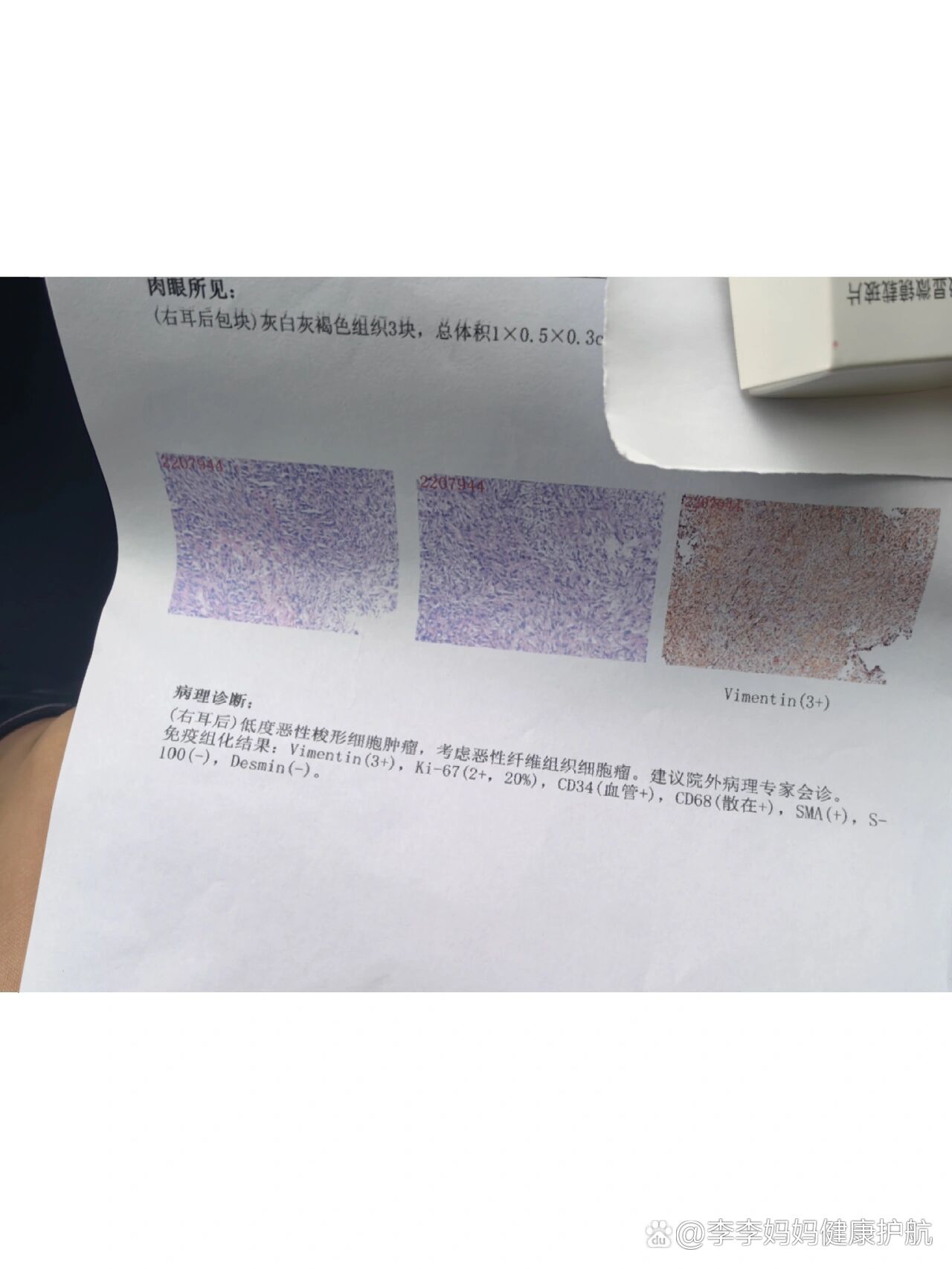 梭形细胞瘤,希望结果不再反转
