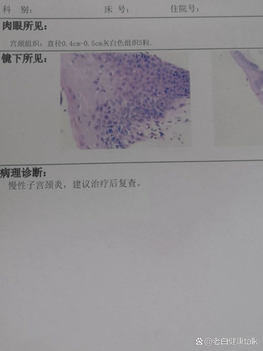 宫颈糜烂,妇检接触性出血