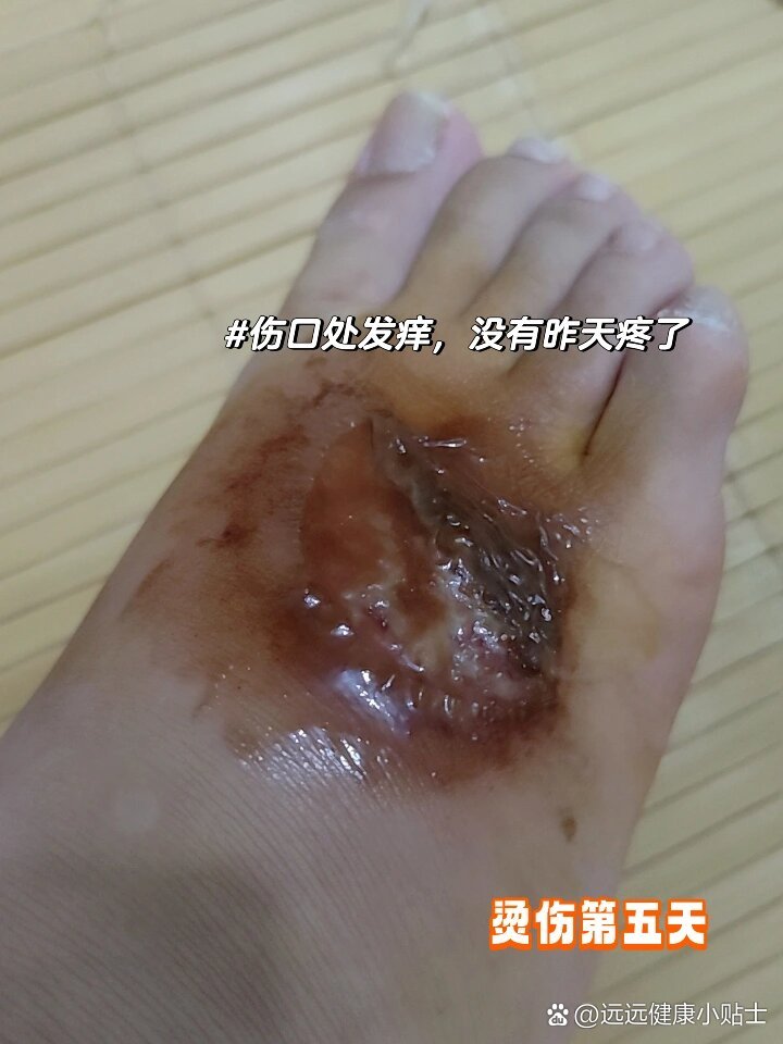 烫伤第五天孕期29周,烫伤第五天,伤口处理:喷碘伏清理创面,涂
