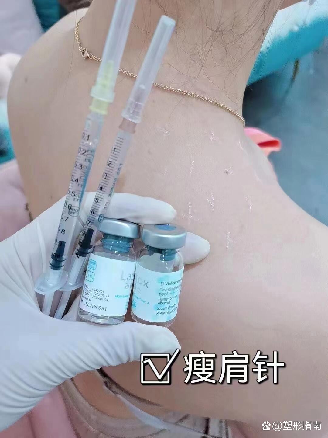 瘦肩针注意事项