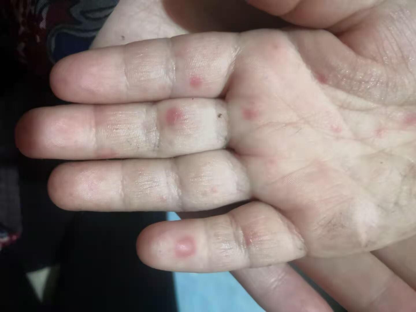孩子手足口病的皮疹表现,家长了解一下