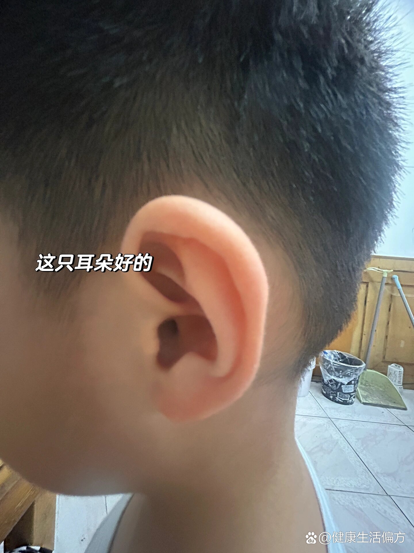 小孩耳屏内侧鼓包,有没有朋友见过这样的