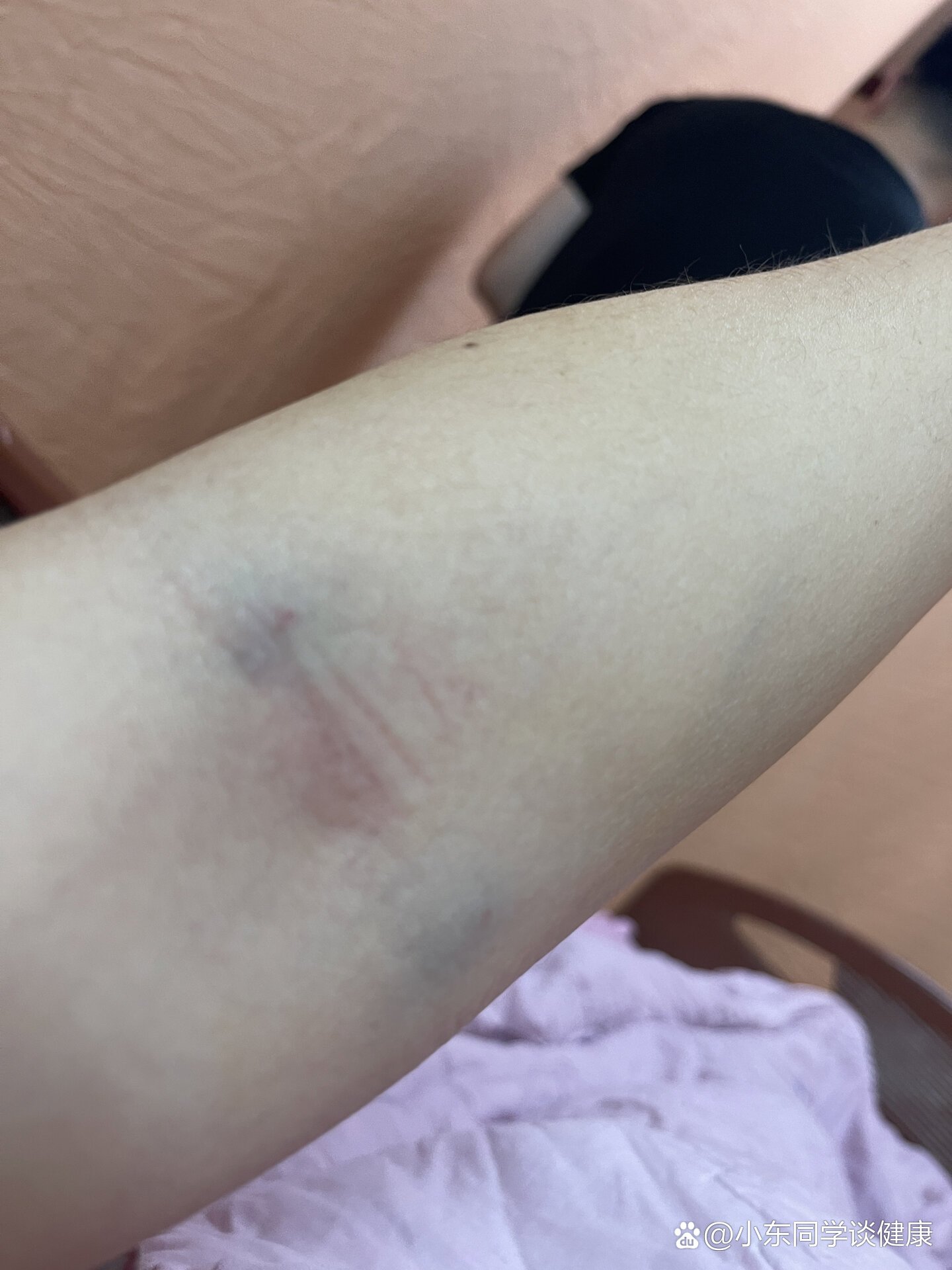 溶血是什麼意思啊?