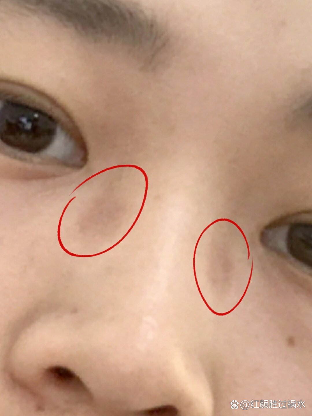 戴眼镜有压痕,鼻梁留红印怎么办?