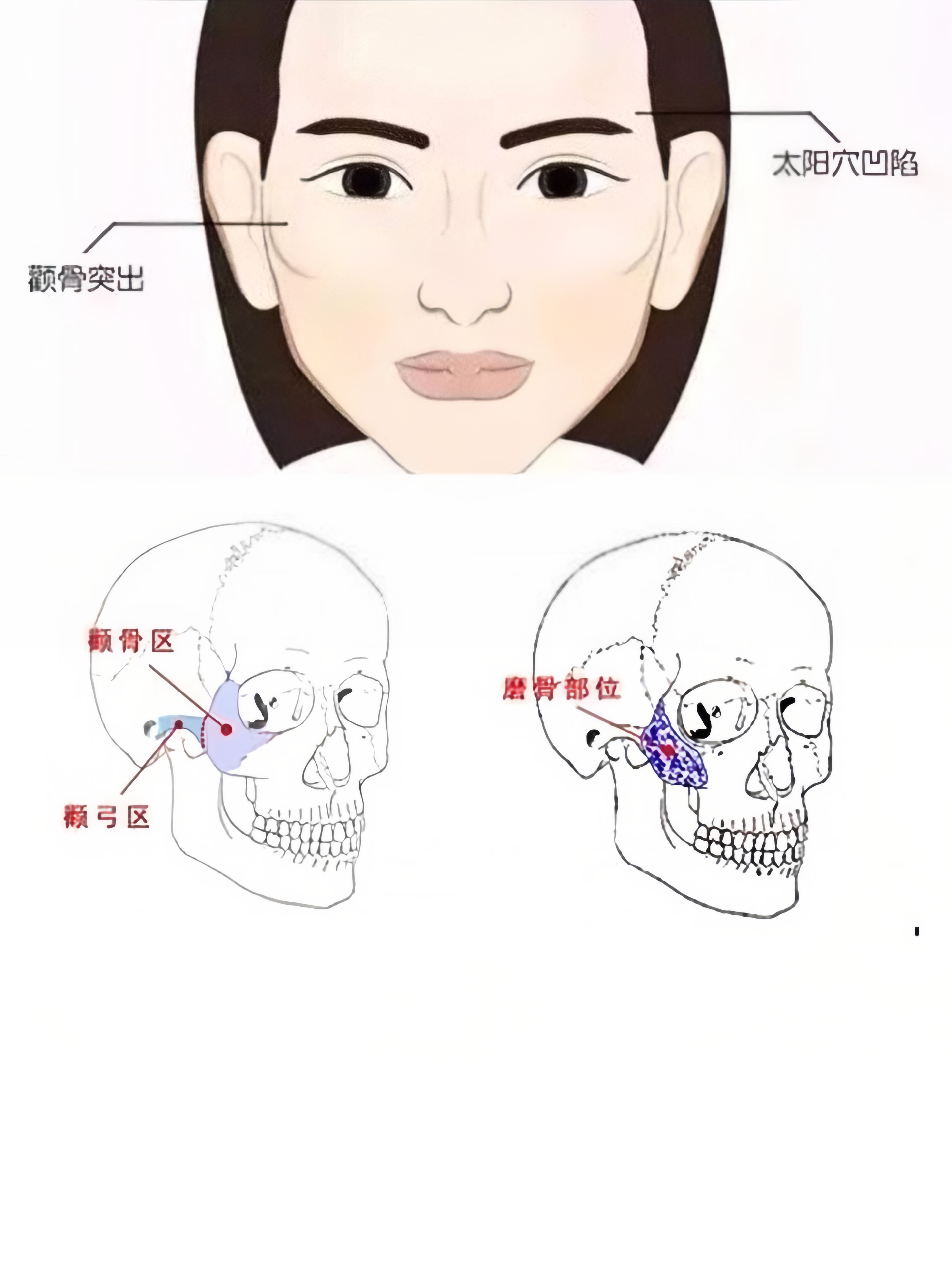 颧骨颧弓整形术图片