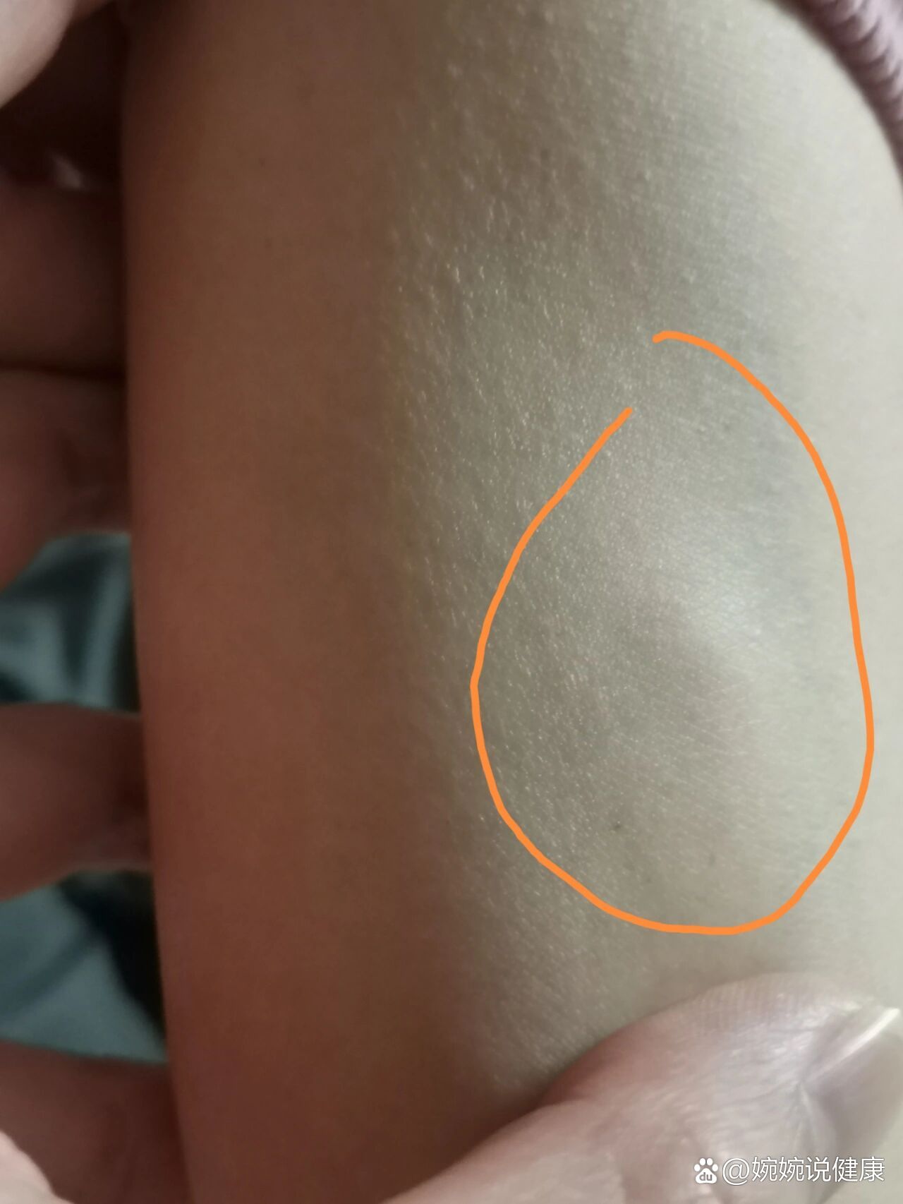 靠近手臂中间的位置有一个小鼓包