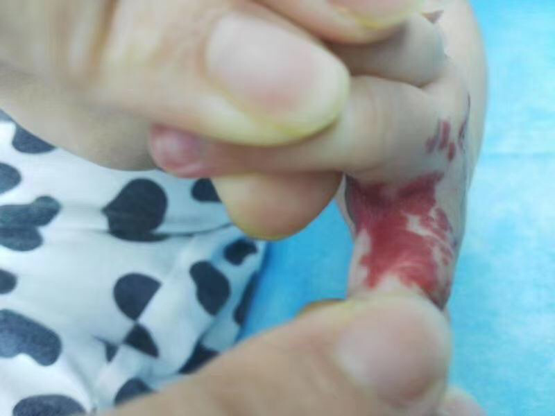 婴儿手指手掌部位血管瘤,经我院微创综合治疗恢复后对比,效果非常明显