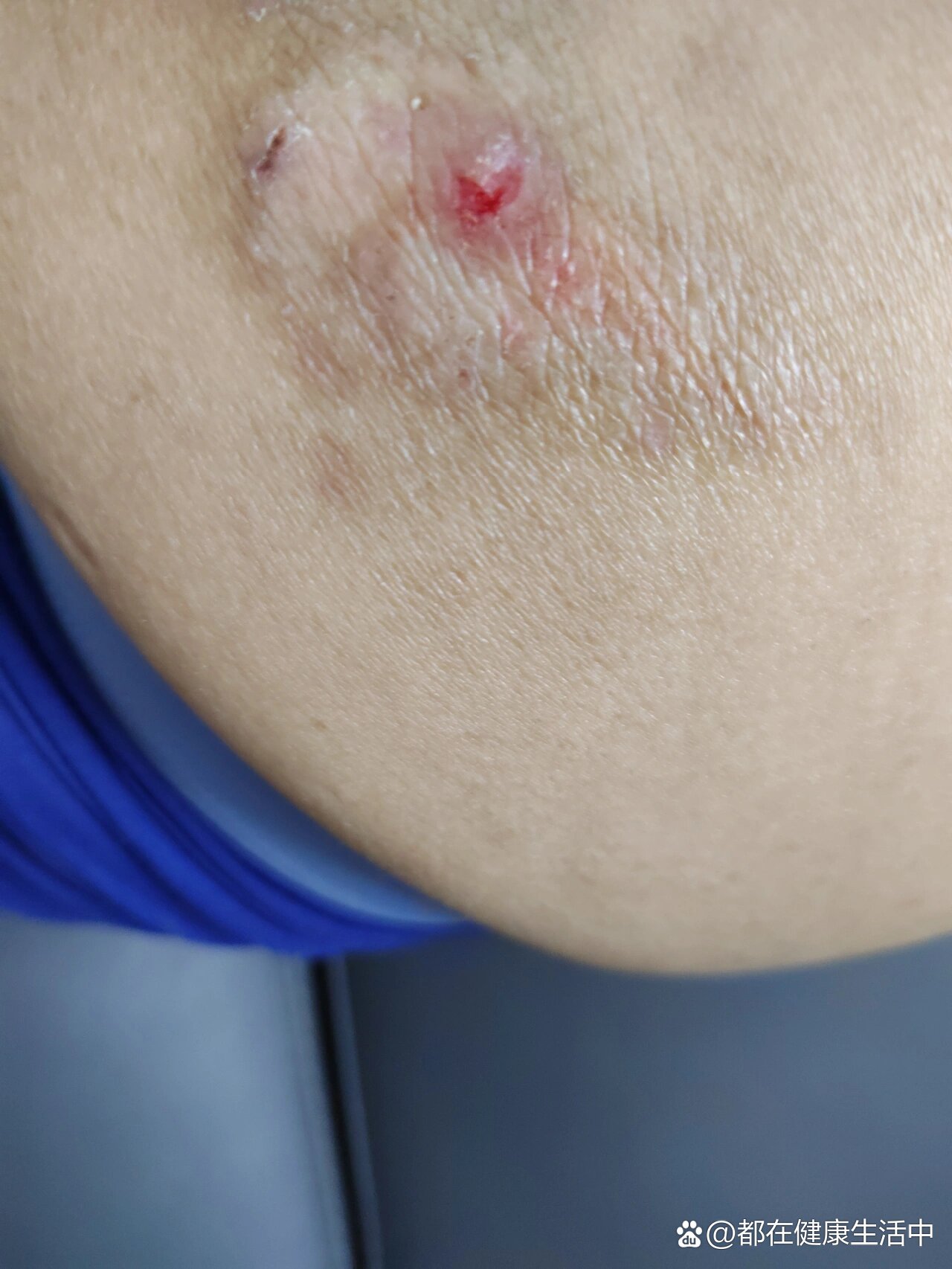  p>坐板疮 br>这个患者屁股上坐板疮,因为搔痒,反复抓挠,疮面不断增大