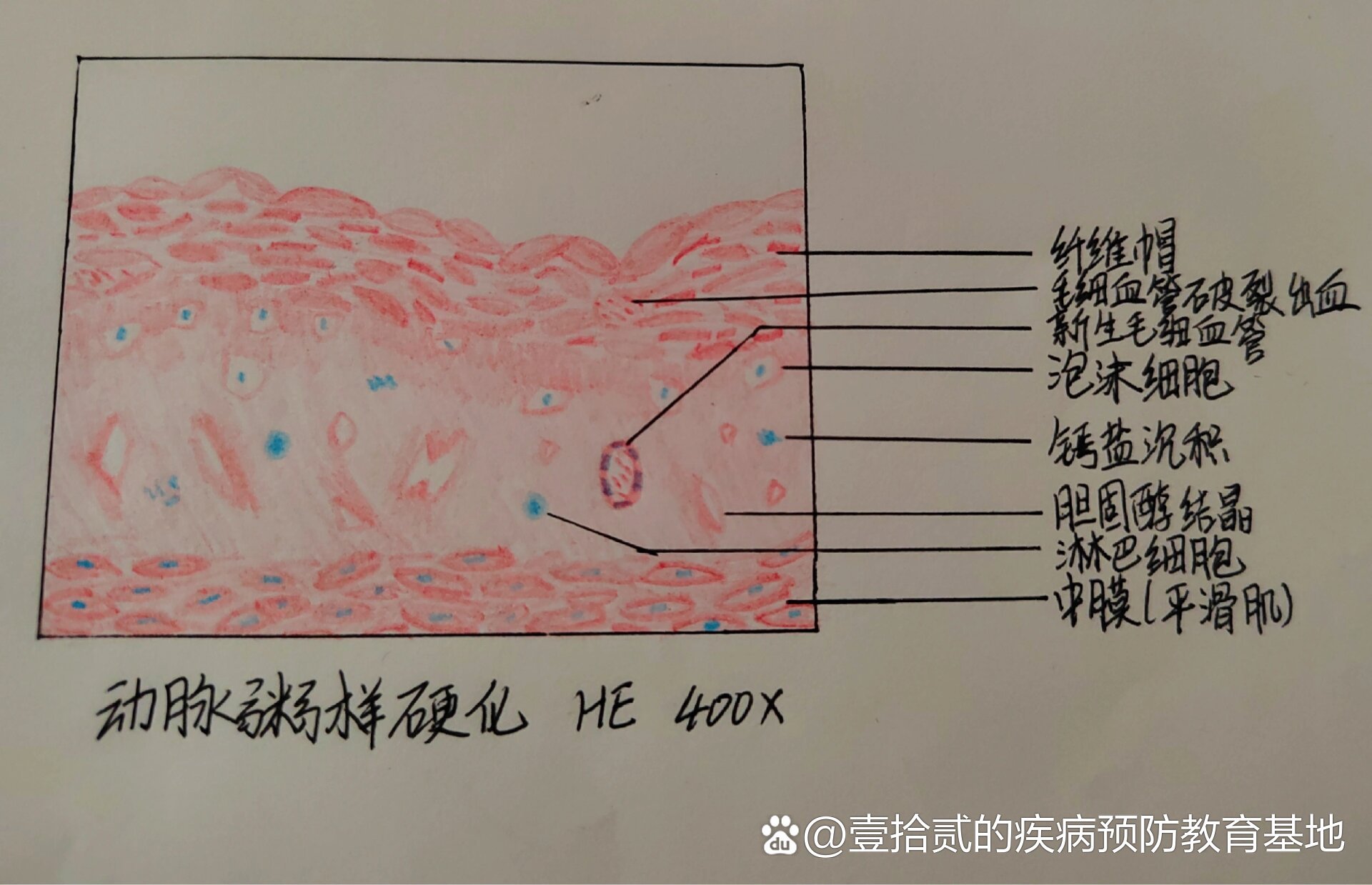 动脉粥样硬化切片图解图片