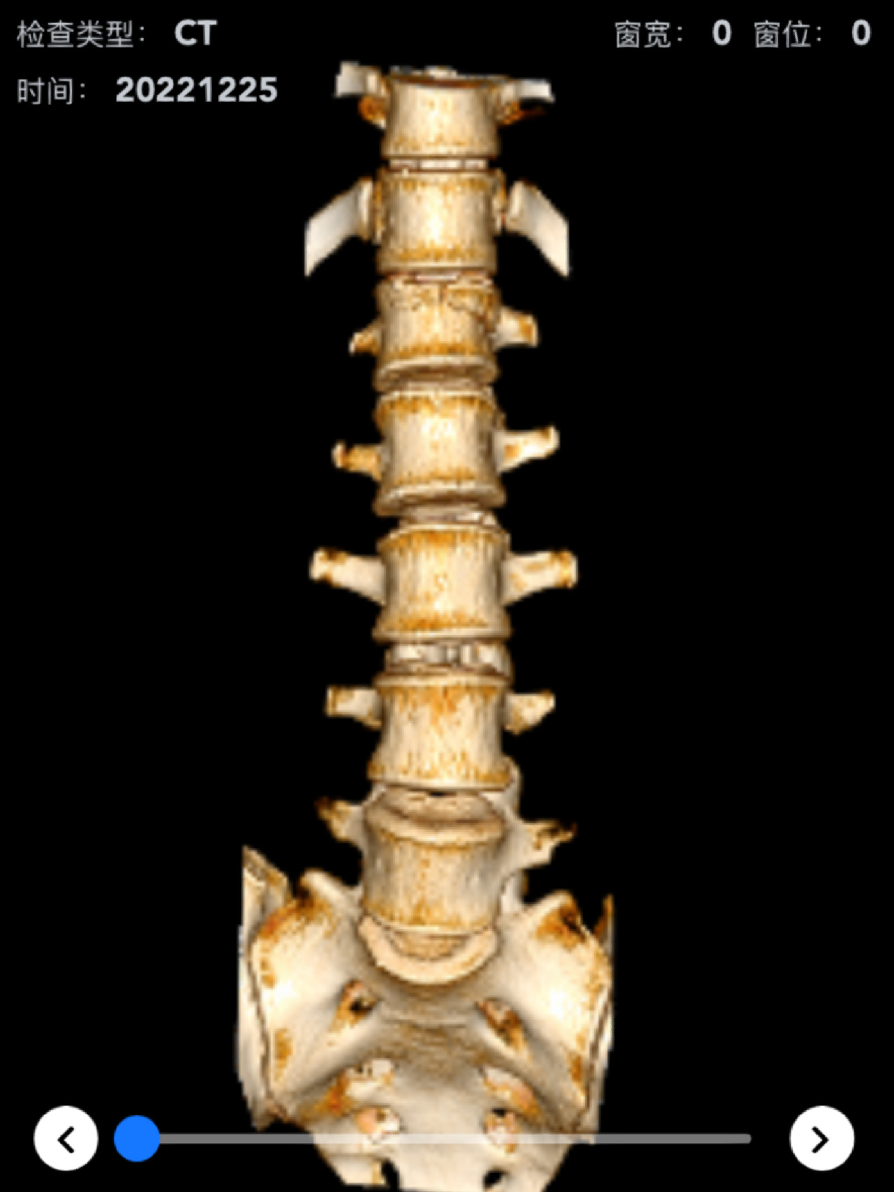 腰椎压缩骨折两个月复查分享
