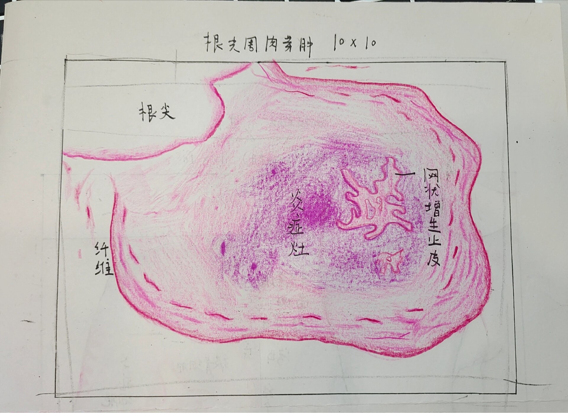 结核性肉芽肿手绘图图片