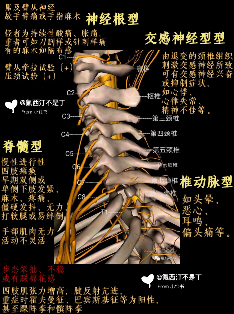 颈椎病的症状表现图片