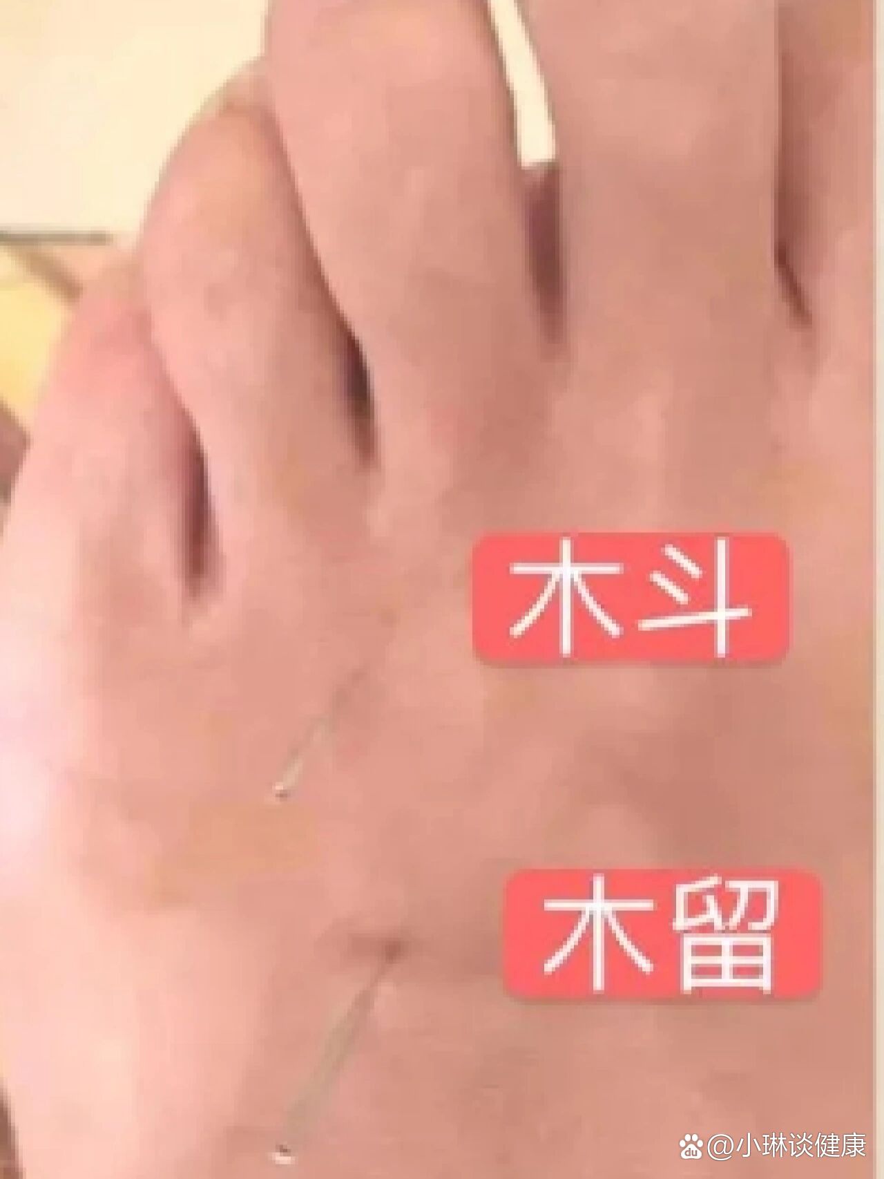  p>木斗,木留穴 br>木斗穴: br>主治:脾肿大(硬块),消化不良,肝病