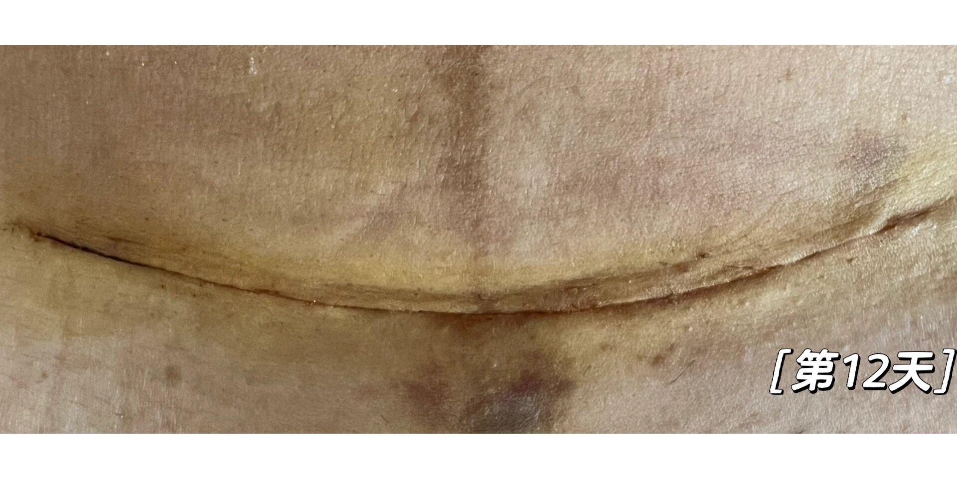 剖腹产横刀刀口