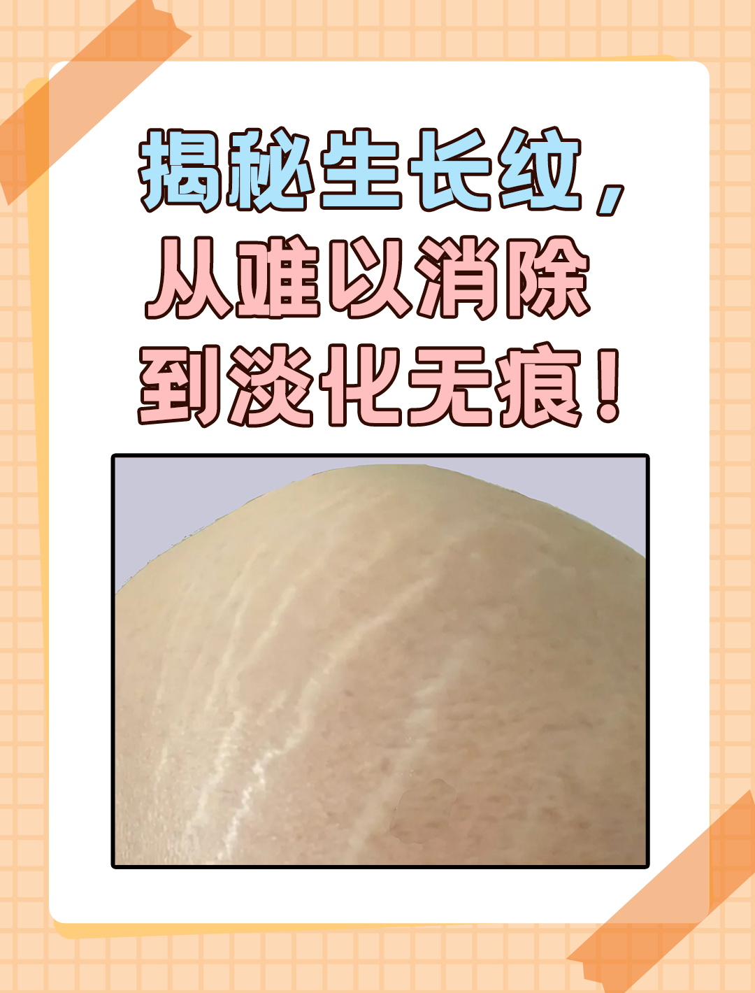 淡化生长纹!揭秘"祛纹"秘诀!