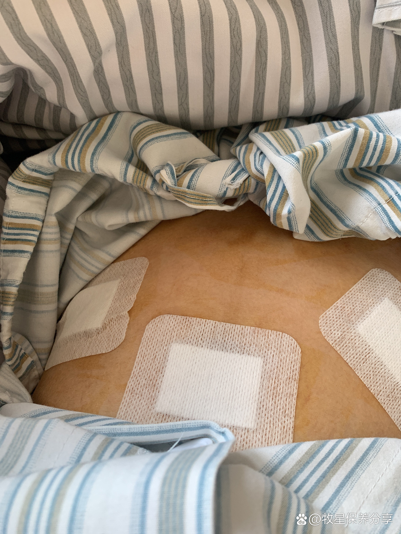 宫腹腔镜手术后的伤口