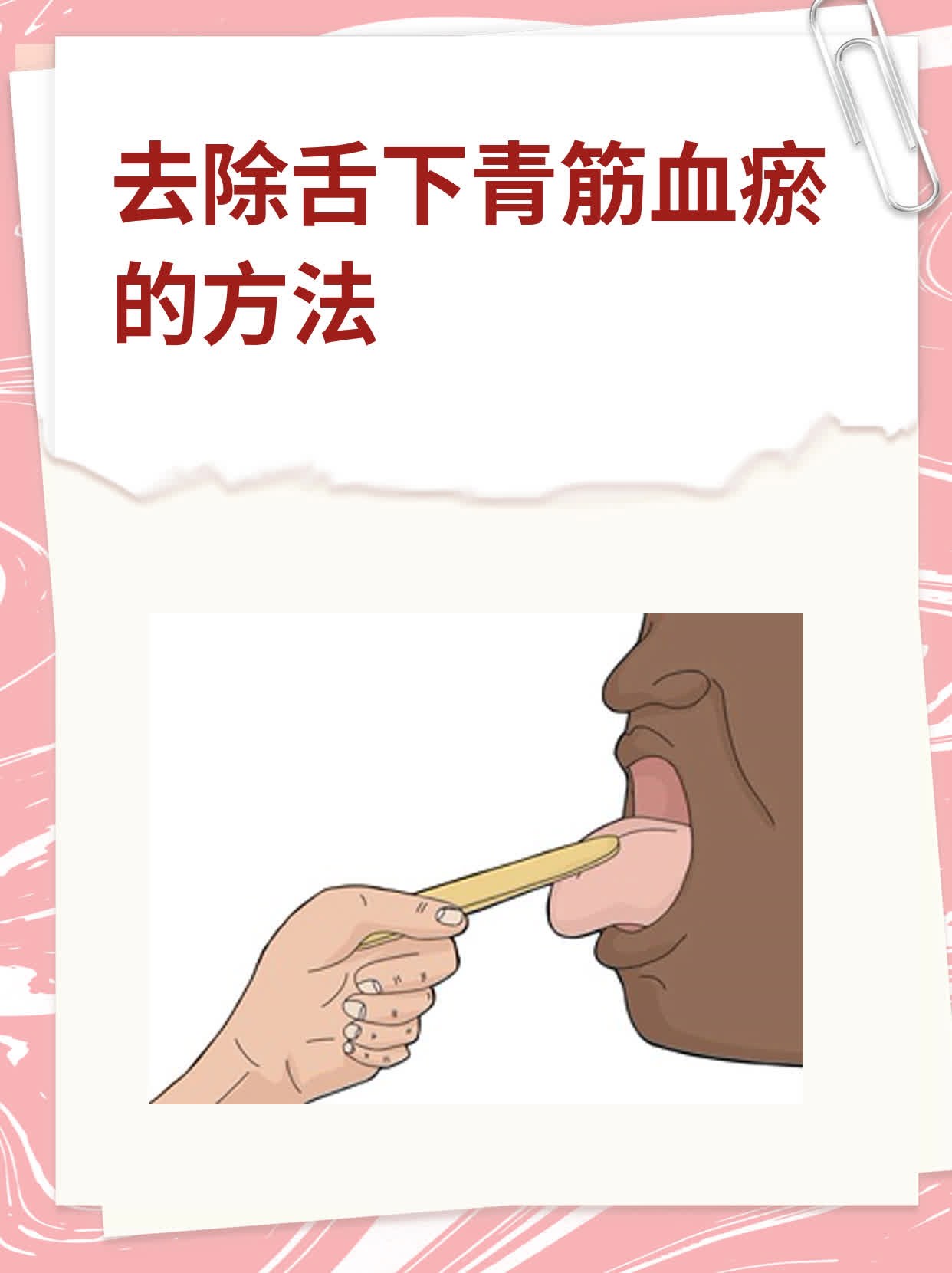 去除舌下青筋血瘀的方法