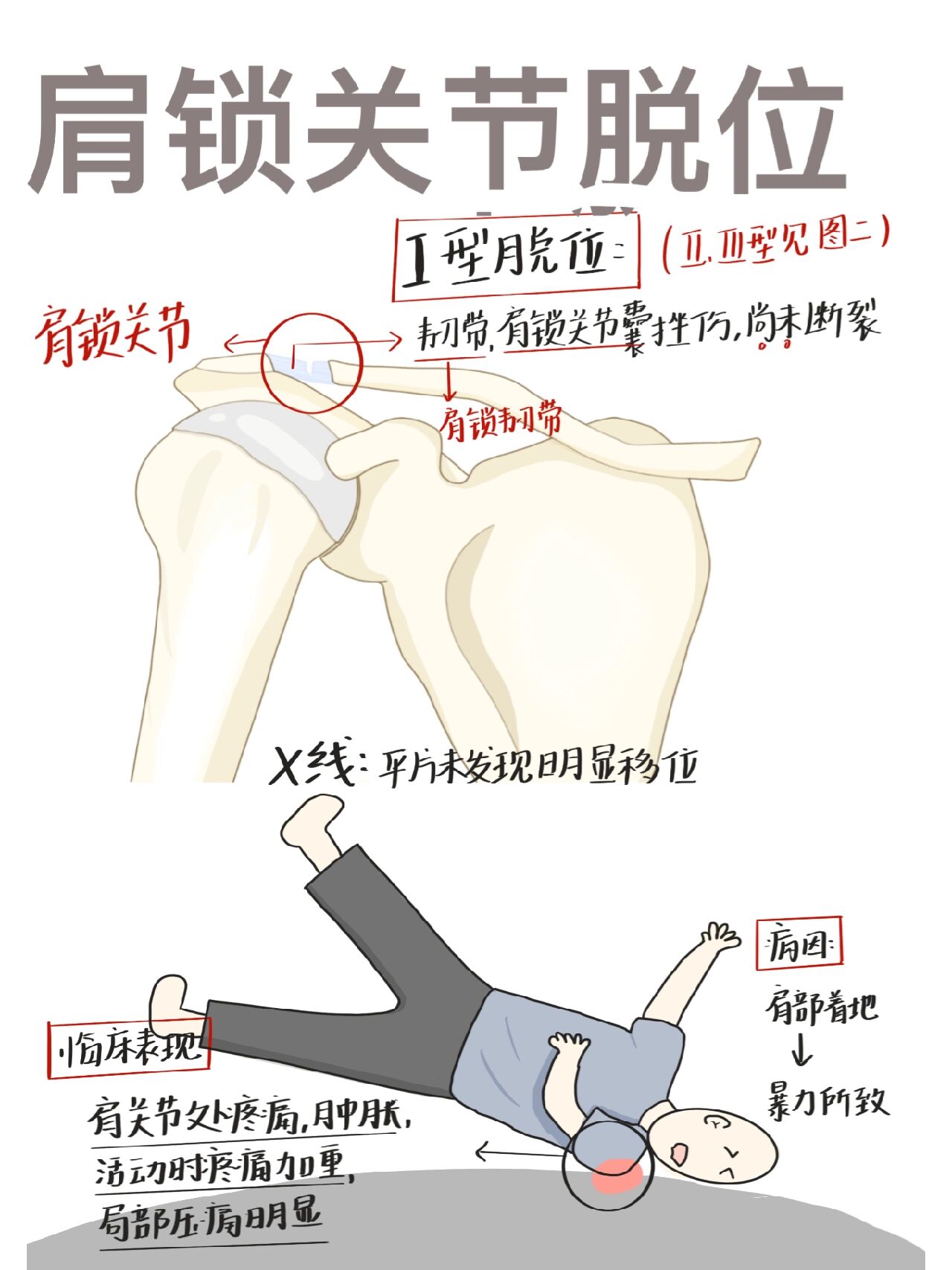 肩锁关节盘图片