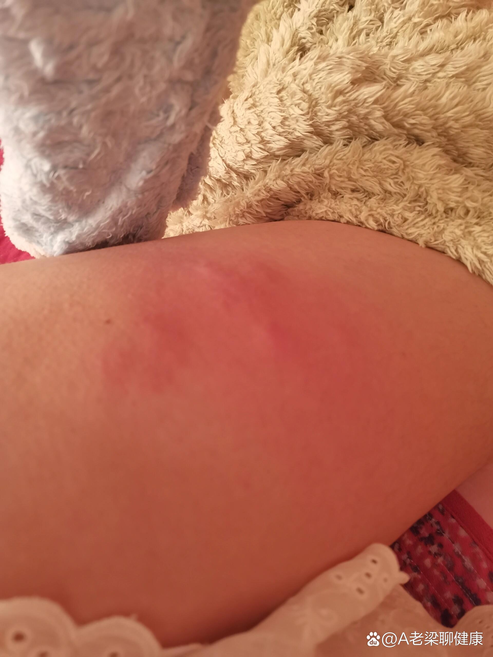 胰岛素打的大腿侧面全是包