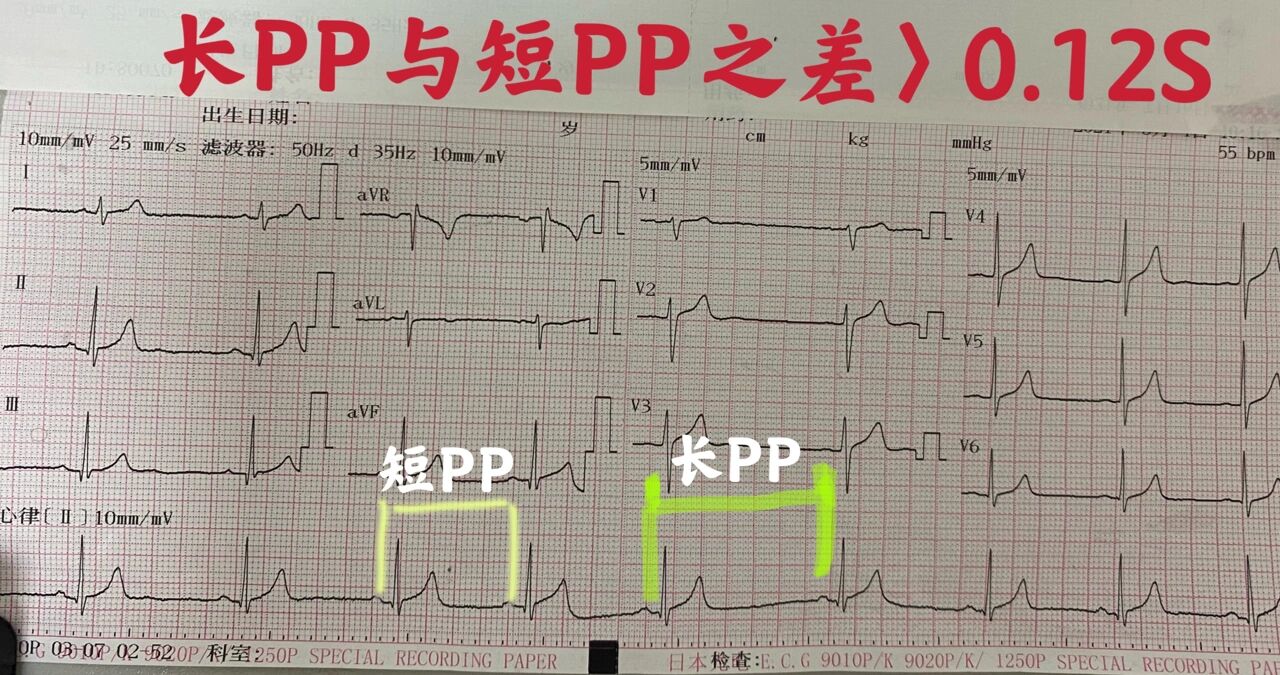 窦性心律不齐图解图片