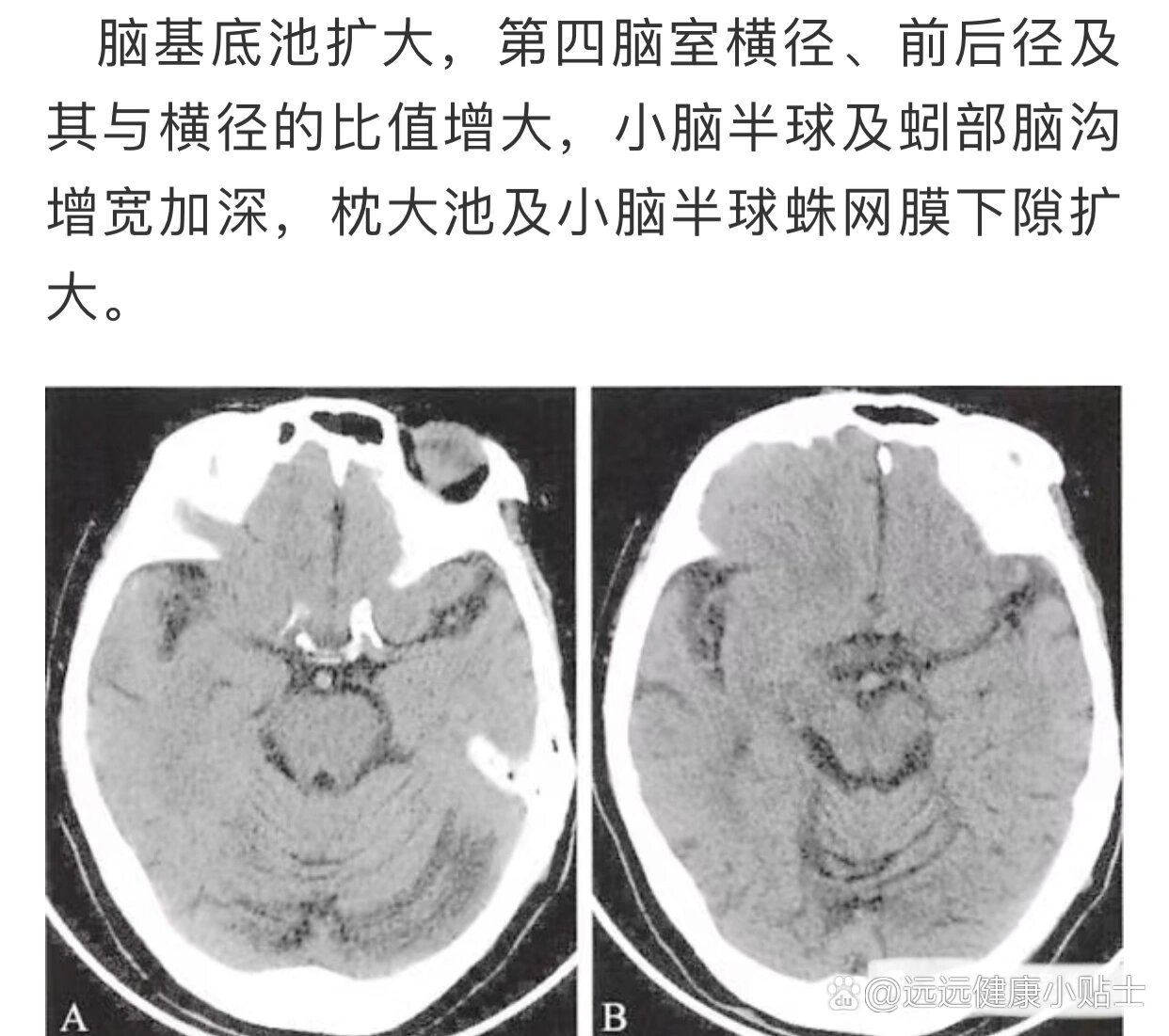 脑萎缩