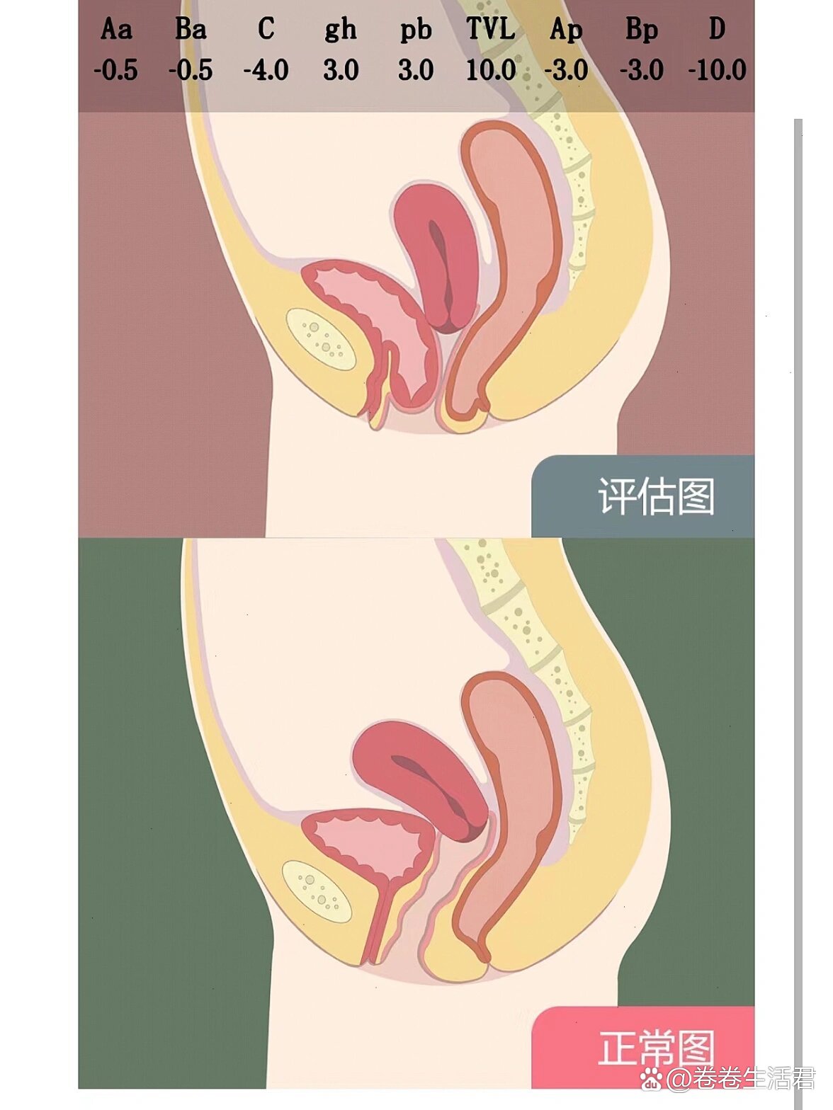 顺产产后盆底肌松弛,脱垂,膨出,痔疮进