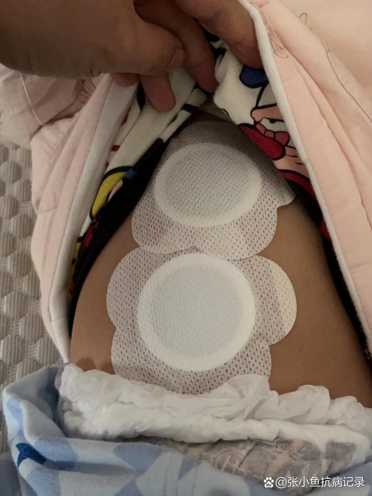 中药贴敷~孩子感冒咳嗽不受罪