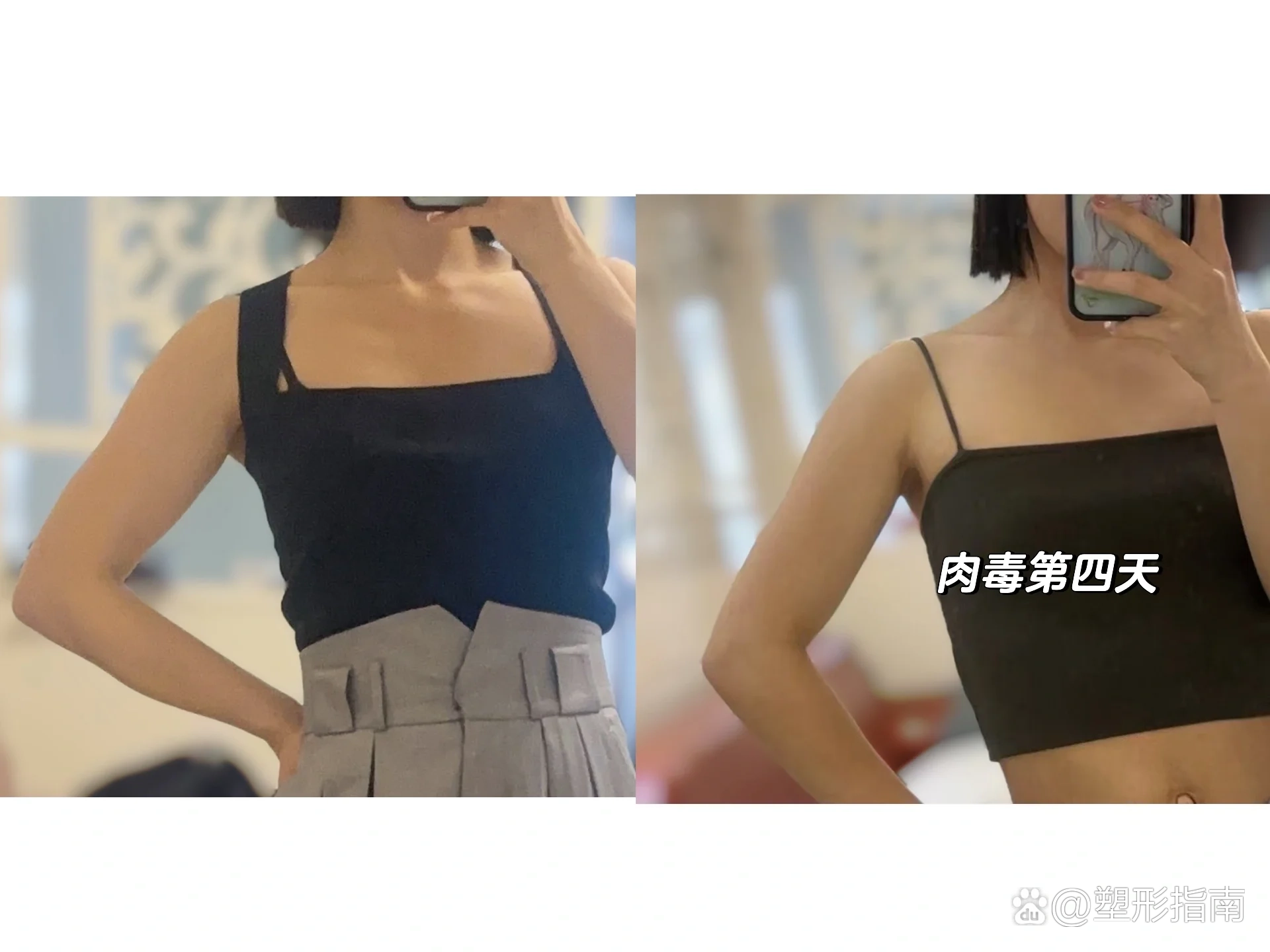 肌肉手臂打肉毒,第四天