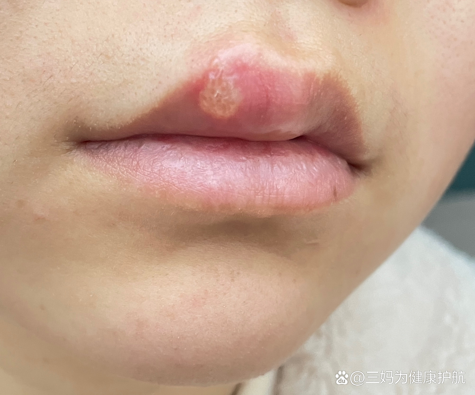每年我的上嘴唇都要起泡肿一次