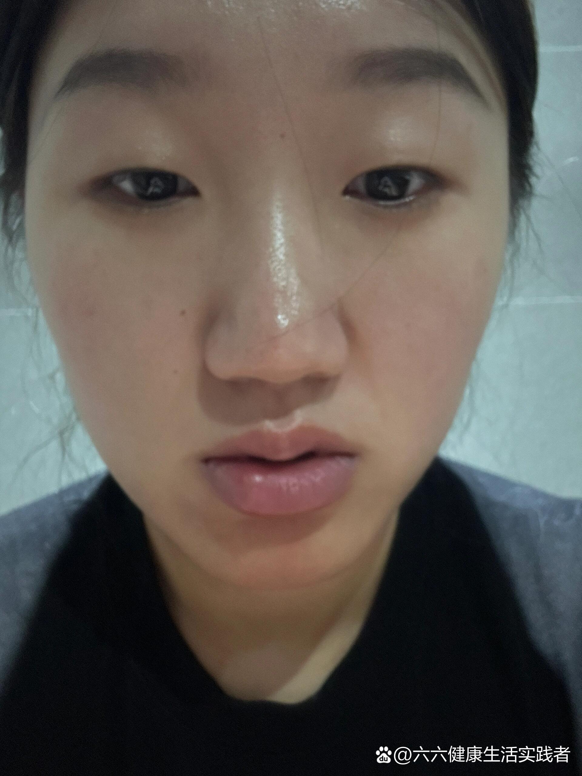 昨天不知道怎么回事,嘴巴肿了,一开始只是一个小白头,没在意.