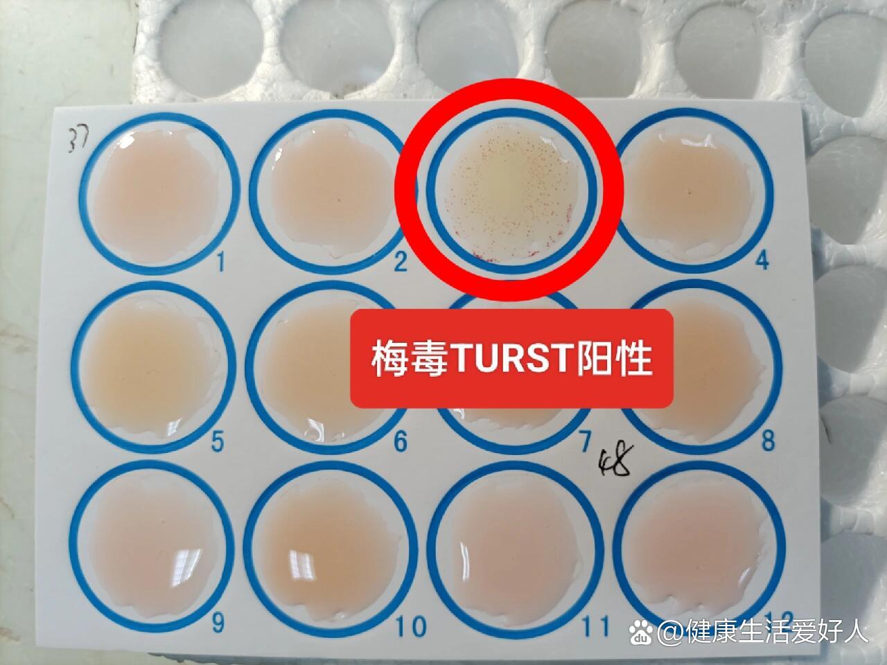 梅毒初筛试验阳性